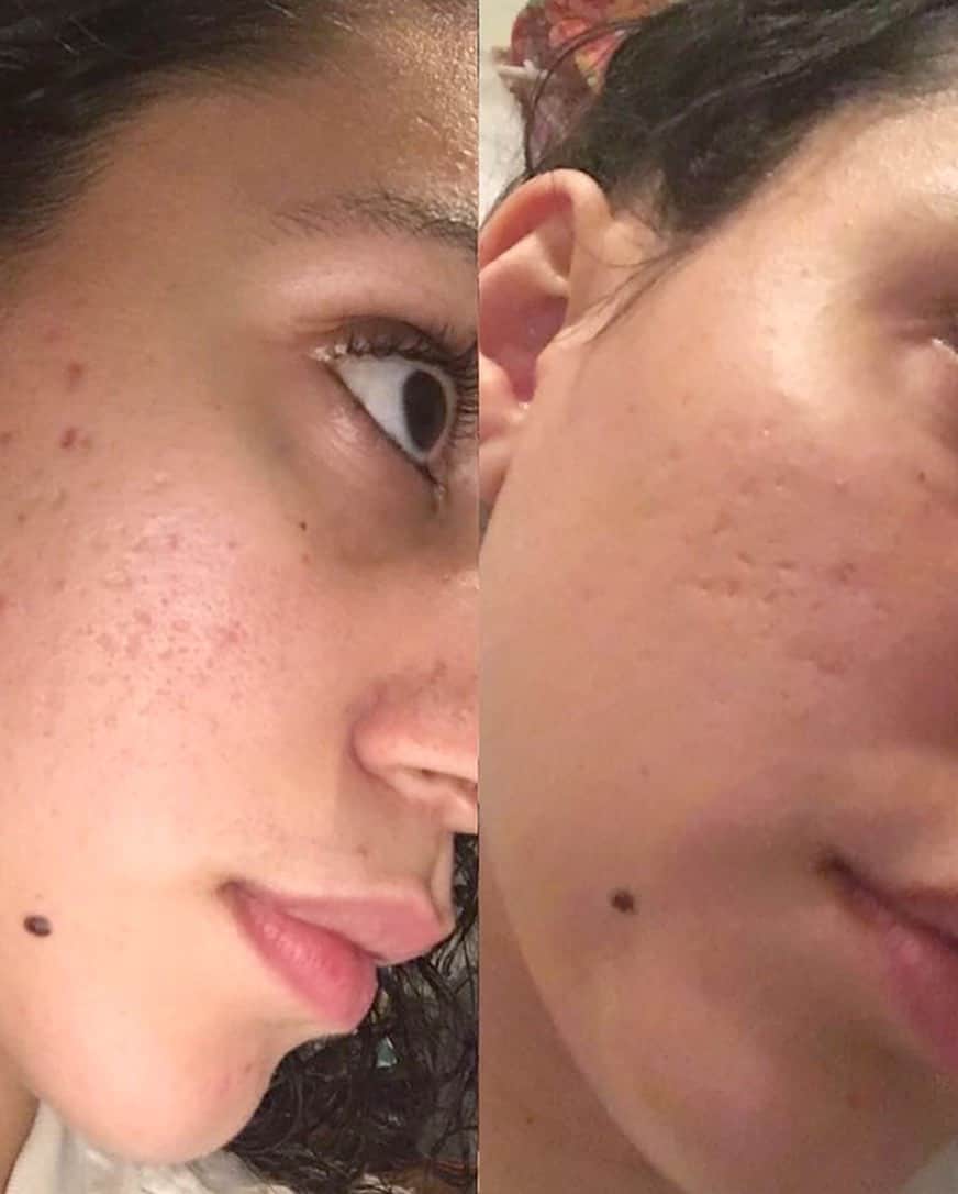 KORA Organicsさんのインスタグラム写真 - (KORA OrganicsInstagram)「Yesterday Brittany @9_sommer shared her #MyKora skin testimonial with us and her positive experience with the Noni Glow Face Oil and Turmeric Brightening and Exfoliating Mask. ⁣⁣ ⁣⁣ ✨✨✨✨✨✨✨✨✨✨✨✨✨✨✨✨⁣⁣ ⁣⁣ Brittany shared her struggle with acne scars and how the Turmeric Brightening  and Exfoliating Mask coupled with the Noni Glow Face Oil reduced the appearance of her acne scars, making her feel “more confident” in her own skin. ⁣⁣ ⁣⁣ ✨✨✨✨✨✨✨✨✨✨✨✨✨✨✨✨⁣⁣ ⁣⁣ If you’re struggling with acne scars, we recommend incorporating the Turmeric Brightening and Exfoliating Mask  twice a week into your skincare ritual. ⁣⁣ ⁣⁣ ✨✨✨✨✨✨✨✨✨✨✨✨✨✨✨✨⁣⁣ ⁣⁣ Use two to three drops of the Noni Glow Face Oil as the last step of your skincare ritual at night to smooth and hydrate the skin. #KORAOrganics #MindBodySkin #NoniGlow⁣⁣ ⁣⁣」7月18日 2時07分 - koraorganics