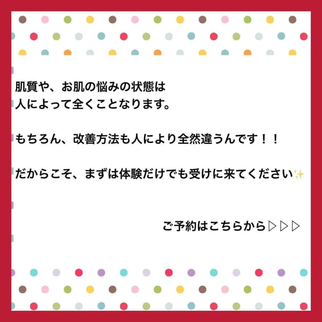 肌質改善専門サロン~Accueil~さんのインスタグラム写真 - (肌質改善専門サロン~Accueil~Instagram)「💙💚19日空きあり💛💜❤ * * 【ご予約はこちら👇🏼】 🌟🌟 @accueil_ikebukuro 🌟🌟 . ※今だけ期間限定クーポンあり . . . 肌荒れの原因は人それぞれなのにも関わらず、 周りの人と同じケアをしていませんか💦？？ * ❌お薬を塗っても飲んでも変わらない、、 ❌食事を気にしても肌が荒れる、、 ❌スキンケアを変えてもイマイチ、、 ❌何かしら常にトラブルが肌にある、、 ❌ニキビが繰り返しできる、、 * * そのお悩み解決できちゃいます😌✨ Accueilは、どのサロンに行っても良くならなかったお客さまたちや、 どの皮膚科に行っても変化がなかったお客さまたちが多く訪れてくださっています🙌💕* * * * もう悩まない！！！ 繰り返さないところまでしっかりと根本改善していきます☺️ そろそろ肌荒れから卒業しませんか？ * →→→初回体験はこちらから👉🏼 @accueil_ikebukuro * * * * Accueilでのお手当は、、 * 機械は一切使いません🙅‍♀️❌ 使うお化粧品は １００％天然の「ミネルヴァ化粧品」🌲🍃 ニキビの炎症がある方・アトピーの方でも 安心して受けていただける事ができる お肌にとても優しいエステです♡♡ * * お肌のお悩みなら、何でもお任せください😊💕 * * ■「インスタ見ました！」 で、 初回体験￥26,000 →→✨￥５，９８０✨ * * * --------当サロンのご予約方法≫--------- *  1️⃣当サロンのインスタTopのURL ⭐『Hotpepper Beauty』の 「instagram限定クーポン」にてご予約可能♡♡ * * 2️⃣インスタのDMからご予約 （下記項目を記載の上、お問い合わせください♪） * 🔶お名前（フルネーム） * 🔶お電話番号 * 🔶希望日時（第１～第３希望） * 🔶ご希望のメニュー * * 3️⃣お電話でのご予約✨ 　03-6912-5705にお願いします♡ ----------------------------------------- * * @accueil_ikebukuro ✨ #ニキビ #ニキビ跡 #毛穴 #乾燥肌 #ニキビ跡ケア #肌荒れ #ニキビ跡改善 #ニキビ肌改善 #ニキビ治療 #保湿 #毛穴の黒ずみ #毛穴の開き #スキンケア #毛穴吸引 #アトピー女子 #ニキビ皮膚科  #美肌ケア  #ニキビ専門 #肌質改善 #背中ニキビ #アトピー肌 #乾燥 #ニキビケア #毛穴ケア #アトピー治療 #肌悩み #スキンケア難民 #肌トラブル改善 #スキンケア大事 #目指せ美肌」7月20日 9時24分 - accueil_ikebukuro