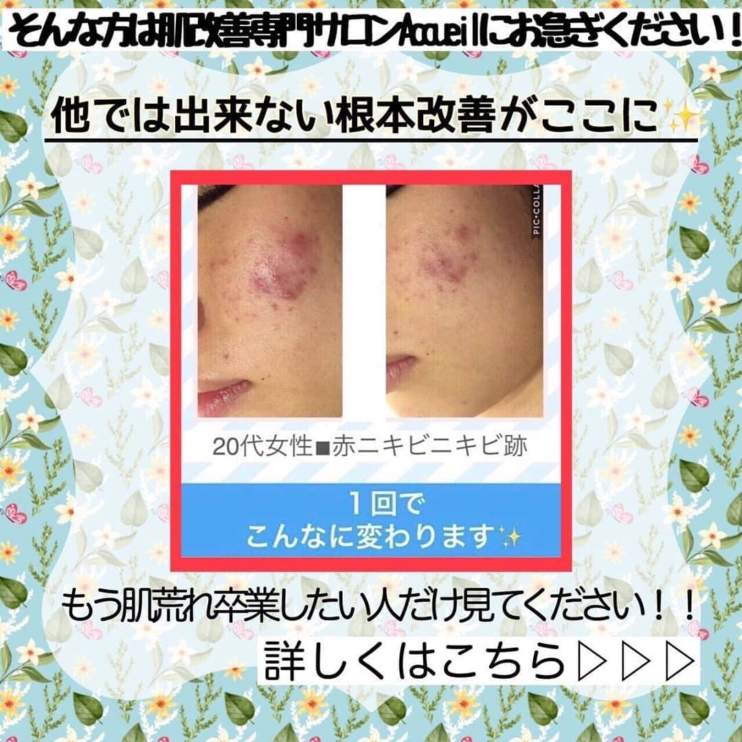 肌質改善専門サロン~Accueil~さんのインスタグラム写真 - (肌質改善専門サロン~Accueil~Instagram)「💙💚❤️7/21 空きあり* * 【ご予約はこちら👇🏼】 🌟🌟 @accueil_ikebukuro 🌟🌟 . ※今だけ期間限定クーポンあり . . . 肌荒れの原因は人それぞれなのにも関わらず、 周りの人と同じケアをしていませんか💦？？ * ❌お薬を塗っても飲んでも変わらない、、 ❌食事を気にしても肌が荒れる、、 ❌スキンケアを変えてもイマイチ、、 ❌何かしら常にトラブルが肌にある、、 ❌ニキビが繰り返しできる、、 * * そのお悩み解決できちゃいます😌✨ Accueilは、どのサロンに行っても良くならなかったお客さまたちや、 どの皮膚科に行っても変化がなかったお客さまたちが多く訪れてくださっています🙌💕* * * * もう悩まない！！！ 繰り返さないところまでしっかりと根本改善していきます☺️ そろそろ肌荒れから卒業しませんか？ * →→→初回体験はこちらから👉🏼 @accueil_ikebukuro * * * * Accueilでのお手当は、、 * 機械は一切使いません🙅‍♀️❌ 使うお化粧品は １００％天然の「ミネルヴァ化粧品」🌲🍃 ニキビの炎症がある方・アトピーの方でも 安心して受けていただける事ができる お肌にとても優しいエステです♡♡ * * お肌のお悩みなら、何でもお任せください😊💕 * * ■「インスタ見ました！」 で、 初回体験￥26,000 →→✨￥５，９８０✨ * * * --------当サロンのご予約方法≫--------- *  1️⃣当サロンのインスタTopのURL ⭐『Hotpepper Beauty』の 「instagram限定クーポン」にてご予約可能♡♡ * * 2️⃣インスタのDMからご予約 （下記項目を記載の上、お問い合わせください♪） * 🔶お名前（フルネーム） * 🔶お電話番号 * 🔶希望日時（第１～第３希望） * 🔶ご希望のメニュー * * 3️⃣お電話でのご予約✨ 　03-6912-5705にお願いします♡ ----------------------------------------- * * @accueil_ikebukuro ✨ #ニキビ #ニキビ跡 #毛穴 #乾燥肌 #ニキビ跡ケア #肌荒れ #ニキビ跡改善 #ニキビ肌改善 #ニキビ治療 #保湿 #毛穴の黒ずみ #毛穴の開き #スキンケア #毛穴吸引 #アトピー女子 #ニキビ皮膚科  #美肌ケア  #ニキビ専門 #肌質改善 #背中ニキビ #アトピー肌 #乾燥 #ニキビケア #毛穴ケア #アトピー治療 #肌悩み #スキンケア難民 #肌トラブル改善 #スキンケア大事 #目指せ美肌」7月20日 19時50分 - accueil_ikebukuro