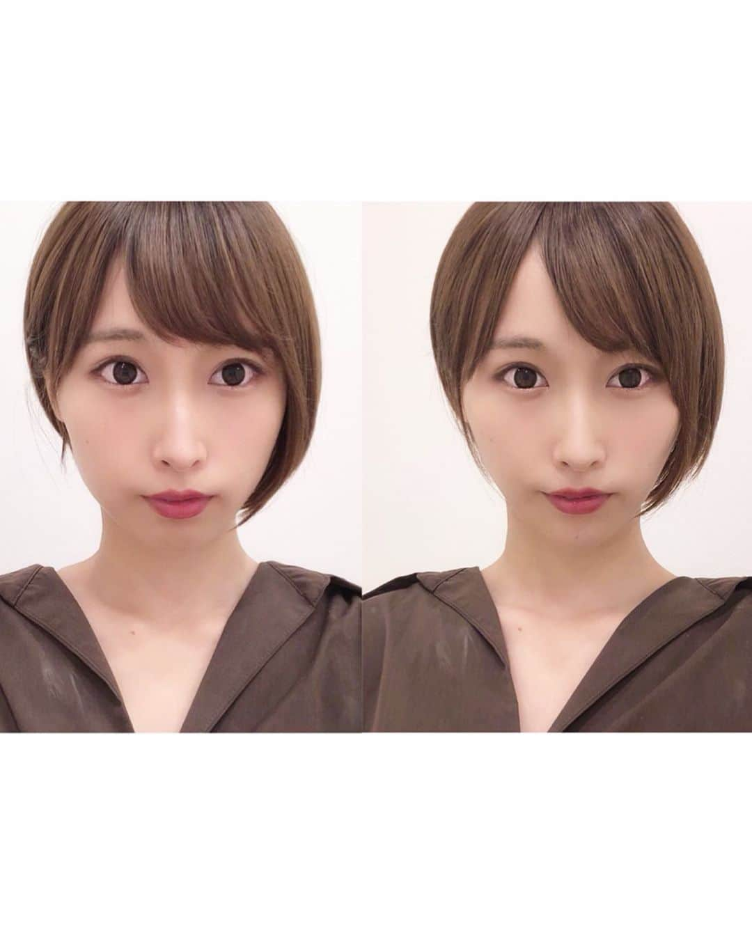 島田玲奈さんのインスタグラム写真 - (島田玲奈Instagram)「. この間、 @a_clinic_ginzaさんでAスレッドとヒアルロン酸してもらってきた！ 谷口先生 (@dr.taniguchi) が担当してくださいました🌻 . 友だちが受けてて、効果すんごいって聞いてたけど、思った以上にすごくてビックリ…😳(笑) 3枚目に左がBeforeで、右がAfterね！ これは、そりゃ皆リピートするわ😢💓 . フェイスラインが変わるだけじゃなくて、肌も綺麗になるって聞いてたけど、ほんまになって驚いておるよ… . あ！髪の毛は最近また @saito_jyunya  さんにカットしてもらいました🥰 . #aスレッド #小顔aスレッド #aclinic #aclinic銀座#aクリニック #エークリニック #美容 #小顔 #美肌#リフトアップ #美容外科 #美容皮膚科 #美容クリニック#山田哲雄 #柴田貴志 #佐藤玲史 #谷口弘樹」7月21日 20時45分 - smd_rn321