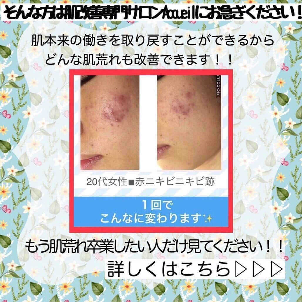 肌質改善専門サロン~Accueil~さんのインスタグラム写真 - (肌質改善専門サロン~Accueil~Instagram)「💙💚22日空きあり💛💜❤ * * 【ご予約はこちら👇🏼】 🌟🌟 @accueil_ikebukuro 🌟🌟 . ※今だけ期間限定クーポンあり . . . 肌荒れの原因は人それぞれなのにも関わらず、 周りの人と同じケアをしていませんか💦？？ * ❌お薬を塗っても飲んでも変わらない、、 ❌食事を気にしても肌が荒れる、、 ❌スキンケアを変えてもイマイチ、、 ❌何かしら常にトラブルが肌にある、、 ❌ニキビが繰り返しできる、、 * * そのお悩み解決できちゃいます😌✨ Accueilは、どのサロンに行っても良くならなかったお客さまたちや、 どの皮膚科に行っても変化がなかったお客さまたちが多く訪れてくださっています🙌💕* * * * もう悩まない！！！ 繰り返さないところまでしっかりと根本改善していきます☺️ そろそろ肌荒れから卒業しませんか？ * →→→初回体験はこちらから👉🏼 @accueil_ikebukuro * * * * Accueilでのお手当は、、 * 機械は一切使いません🙅‍♀️❌ 使うお化粧品は １００％天然の「ミネルヴァ化粧品」🌲🍃 ニキビの炎症がある方・アトピーの方でも 安心して受けていただける事ができる お肌にとても優しいエステです♡♡ * * お肌のお悩みなら、何でもお任せください😊💕 * * ■「インスタ見ました！」 で、 初回体験￥26,000 →→✨￥５，９８０✨ * * * --------当サロンのご予約方法≫--------- *  1️⃣当サロンのインスタTopのURL ⭐『Hotpepper Beauty』の 「instagram限定クーポン」にてご予約可能♡♡ * * 2️⃣インスタのDMからご予約 （下記項目を記載の上、お問い合わせください♪） * 🔶お名前（フルネーム） * 🔶お電話番号 * 🔶希望日時（第１～第３希望） * 🔶ご希望のメニュー * * 3️⃣お電話でのご予約✨ 　03-6912-5705にお願いします♡ ----------------------------------------- * * @accueil_ikebukuro ✨ #ニキビ #ニキビ跡 #毛穴 #乾燥肌 #ニキビ跡ケア #肌荒れ #ニキビ跡改善 #ニキビ肌改善 #ニキビ治療 #保湿 #毛穴の黒ずみ #毛穴の開き #スキンケア #毛穴吸引 #アトピー女子 #ニキビ皮膚科  #美肌ケア  #ニキビ専門 #肌質改善 #背中ニキビ #アトピー肌 #乾燥 #ニキビケア #毛穴ケア #アトピー治療 #肌悩み #スキンケア難民 #肌トラブル改善 #スキンケア大事 #目指せ美肌」7月21日 20時57分 - accueil_ikebukuro