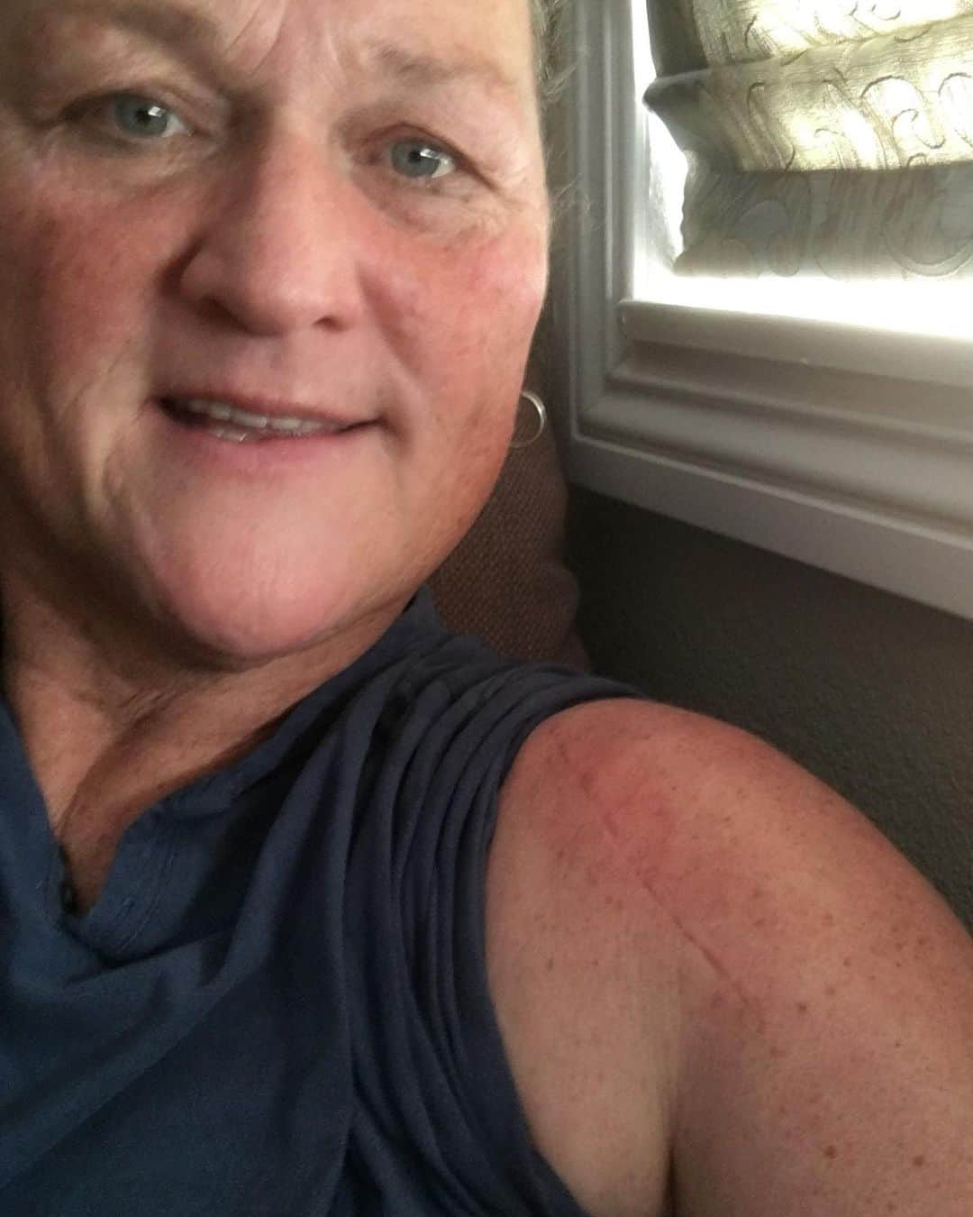 ドット=マリー・ジョーンズさんのインスタグラム写真 - (ドット=マリー・ジョーンズInstagram)「I CAN'T BELIEVE ITS BEEN 5 WEEKS TODAY !! TOTAL SHOULDER REPLACEMENT AND THE SCAR IS NOTHING!! PLUS I HAD THE BEST NURSE @bridgettcjones 💪🏻💪🏻💪🏻❤️🏆😍」7月24日 8時40分 - dotmariejones