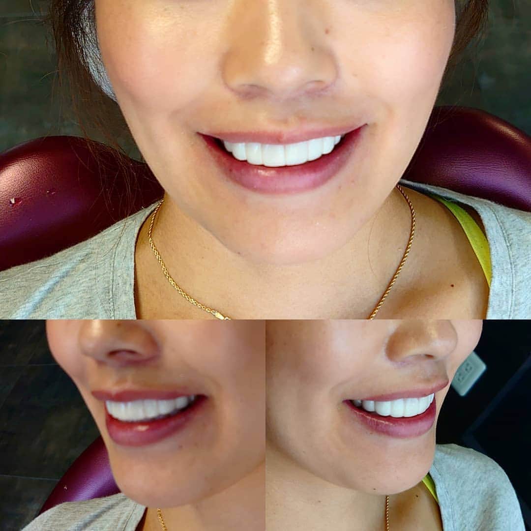 五十嵐一誠さんのインスタグラム写真 - (五十嵐一誠Instagram)「セラミックアート❗  美しい顔を作るための 美しい歯と歯並びは 顔とのバランスが命です」7月25日 16時31分 - superdentist5