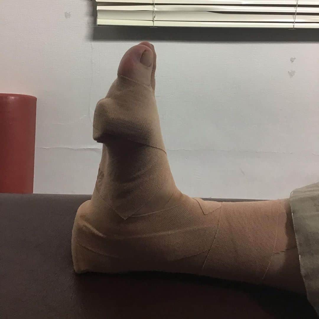 大阪の整体師 庄本さんのインスタグラム写真 - (大阪の整体師 庄本Instagram)「【足のアーチが崩れて、つま先が痛い】 . ついさっき診た症例🚑 . 重度の外反母趾があり体重のかけ方が悪く、2・3趾の付け根が強く炎症していました☠️. . ラジオ波や徒手による施術の後に3日間の固定としました✋ . 足を引きずりながら来院していましたが帰りはスタスタ歩いていたので3日後が楽しみ👀. . #外反母趾 #外反母趾治療 #福島区」7月29日 21時26分 - shomoto.free