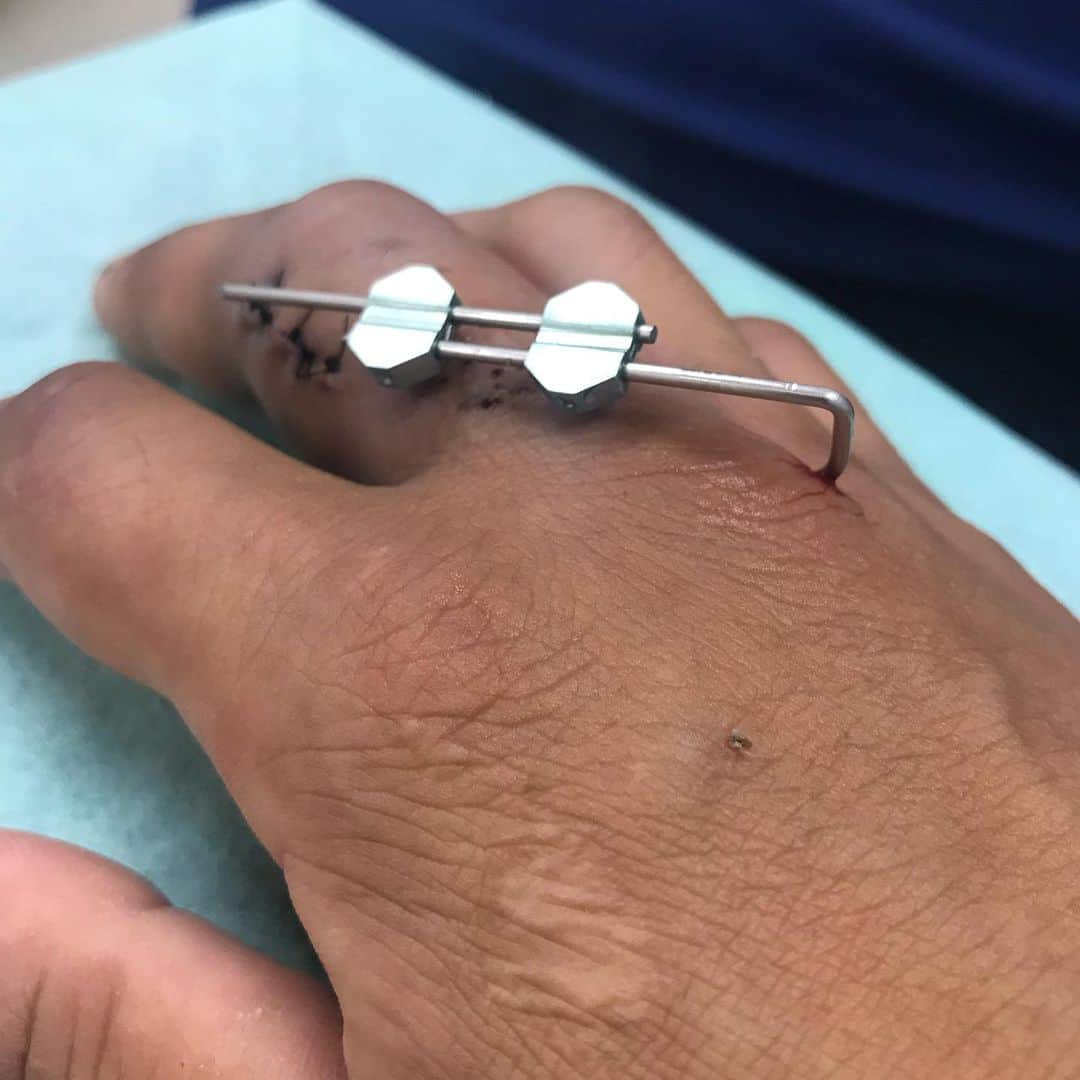 小川裕之さんのインスタグラム写真 - (小川裕之Instagram)「My finger became like this after surgery. It looks like Frankenstein!! I wanna ride a bike!! 指は手術して創外固定という方法で固定してあります。見た目フランケン仕様(笑 早くバイク乗れるようにならなきゃなー(汗  #ogaチャンネル」7月30日 13時03分 - ogastunt