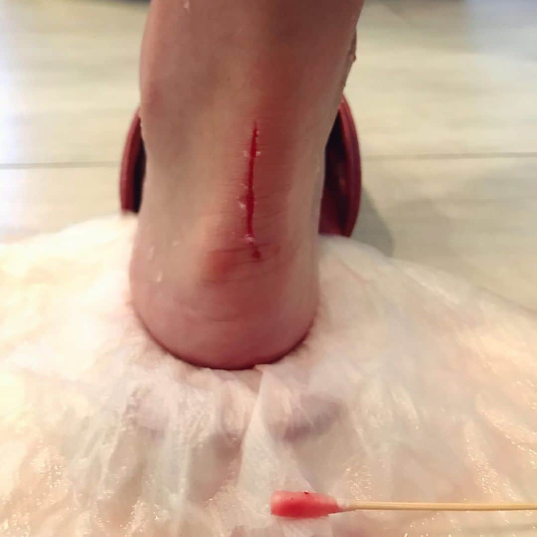 Dewi Chienさんのインスタグラム写真 - (Dewi ChienInstagram)「來～跟你們說個故事。 - 今天下午有個人急著要出門去運動，不小心就刮傷腳，慢慢走去客廳要擦藥時才發現血已流到拖鞋上都是，但不太痛想說稍微止血一下應該就沒事，結果居然有點血流不止⋯只好去醫院了⋯最後縫了五針！打了破傷風！還被醫生規定十天不能運動！（史上最殘念） 真是欲速則不達～～～～～主角就是我本人，謝謝。 - 💉P.S.照片有點血腥！慎入！（但最後一張超好笑） - #回家後室友送我一個剛從日本帶回來的御守#好幽默」8月1日 22時46分 - dewichien