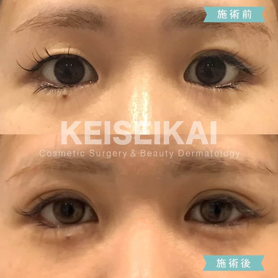 恵聖会クリニックさんのインスタグラム写真 - (恵聖会クリニックInstagram)「⠀ 「なりたいキレイ」応援します！！ ⠀ 華やかな印象✨を与える平行型の二重まぶた。 施術を受けられる患者様にも人気のラインです🏆 ⠀ 元々奥二重だったモニター様。 埋没法のみで、できる限り平行なラインにしてほしいとのご希望でした。 二重幅の左右差も解消されて、華やかで整った目元になられましたね😍 ⠀ カウンセリングは無料です。 施術方法やなりたい二重の形など、あなたのご希望をお聞かせください。 できる限りご希望に添えるよう、最適な方法をご提案させていただきます。 ⠀ 8月は夏休み期間中ということもあり、ご予約が混みあいます。 ご予約をご希望の方はお早めにご連絡ください。 ⠀ ⠀ 💴MT埋没法3点留め/1年保証：46,000円(税抜) 🚿シャワー：当日から可能(顔は濡らさず) 🛁洗顔・メイク：翌日から可能 ⚠️リスク：腫れ・内出血・膿ほう・結膜浮腫・感染症・血腫 ⠀ #二重になりたい #アイプチ卒業 #アイプチいらず #二重術 #二重整形 #二重まぶた #埋没法 #二重埋没 #二重埋没法 #埋没法二重術 #平行型二重 #恵聖会クリニック #恵聖モニター #整形 #美容整形 #プチ整形 #美容クリニック #美容外科」8月5日 18時58分 - keiseikai