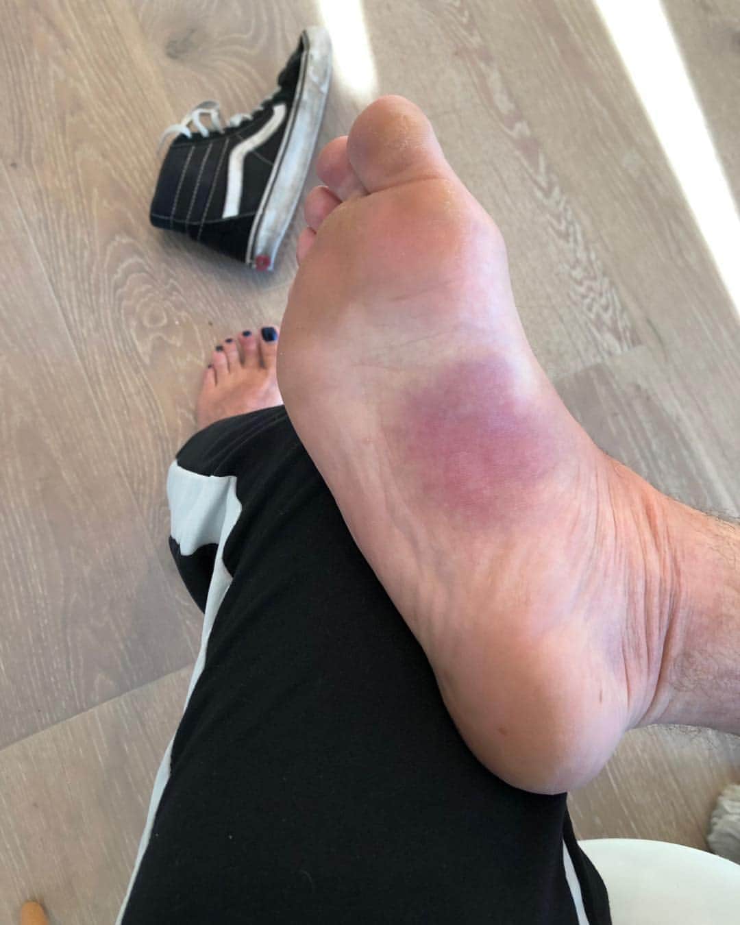 ブレッキン・メイヤーのインスタグラム：「Dear Bee that Stung the Bottom of my Foot, you stung me and had your stinger ripped out along with a lot of your abdomen and then you died. I now have a very swollen and gross foot I can’t walk on. Lose/Lose am I right? #RIPJeffTheBee #YesHisNameWasJeffHeToldMe #Ow」