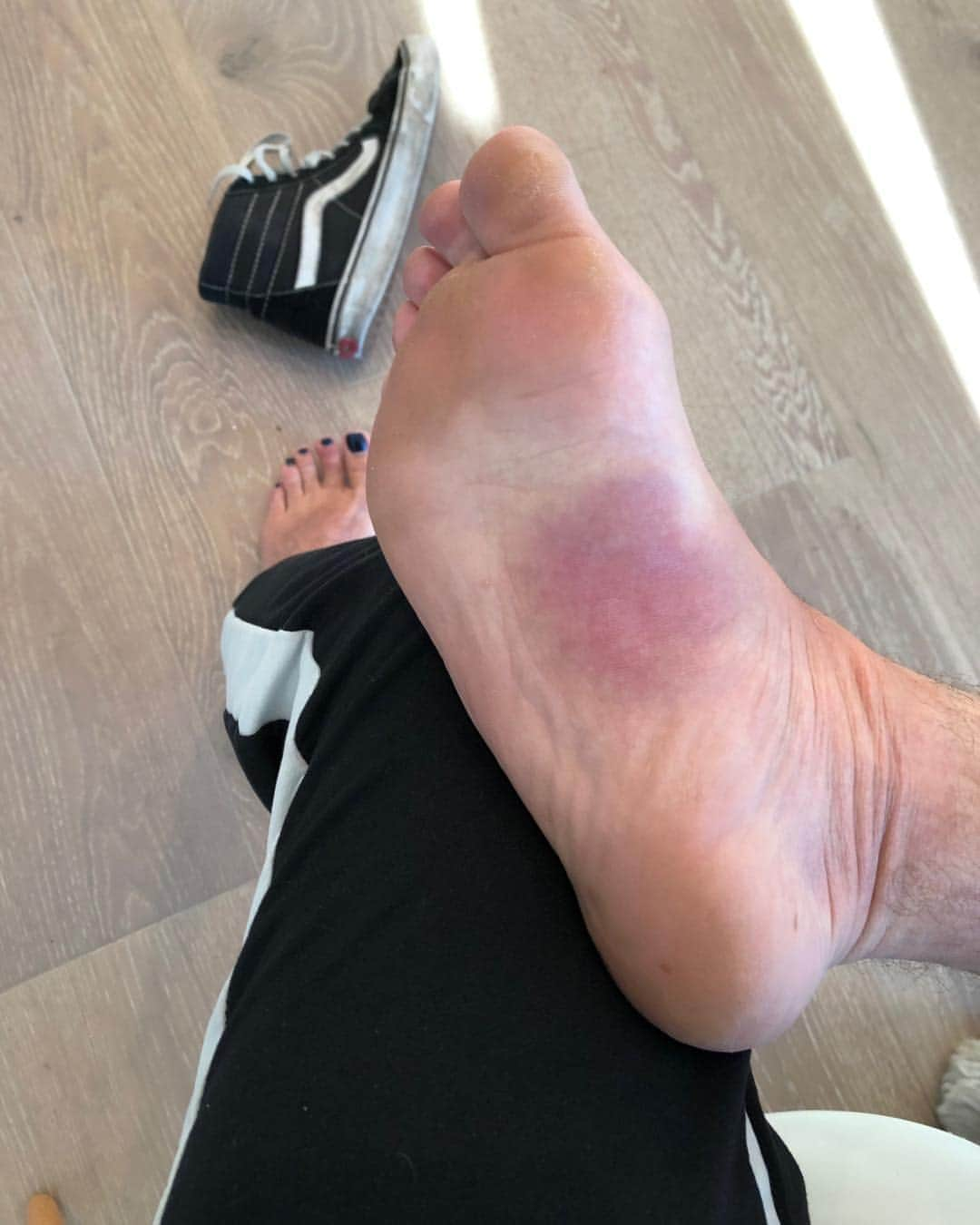 ブレッキン・メイヤーさんのインスタグラム写真 - (ブレッキン・メイヤーInstagram)「Dear Bee that Stung the Bottom of my Foot, you stung me and had your stinger ripped out along with a lot of your abdomen and then you died. I now have a very swollen and gross foot I can’t walk on. Lose/Lose am I right? #RIPJeffTheBee #YesHisNameWasJeffHeToldMe #Ow」8月6日 10時40分 - breckinmeyer