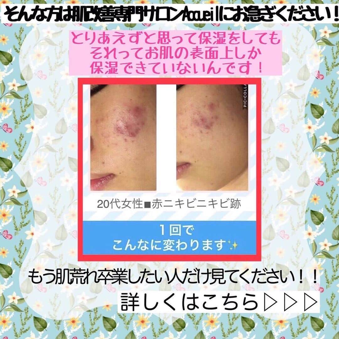 肌質改善専門サロン~Accueil~さんのインスタグラム写真 - (肌質改善専門サロン~Accueil~Instagram)「💙💚❤️8/20 空きあり* * 【ご予約はこちら👇🏼】 🌟🌟 @accueil_ikebukuro 🌟🌟 . ※今だけ期間限定クーポンあり . . . 肌荒れの原因は人それぞれなのにも関わらず、 周りの人と同じケアをしていませんか💦？？ * ❌お薬を塗っても飲んでも変わらない、、 ❌食事を気にしても肌が荒れる、、 ❌スキンケアを変えてもイマイチ、、 ❌何かしら常にトラブルが肌にある、、 ❌ニキビが繰り返しできる、、 * * そのお悩み解決できちゃいます😌✨ Accueilは、どのサロンに行っても良くならなかったお客さまたちや、 どの皮膚科に行っても変化がなかったお客さまたちが多く訪れてくださっています🙌💕* * * * もう悩まない！！！ 繰り返さないところまでしっかりと根本改善していきます☺️ そろそろ肌荒れから卒業しませんか？ * →→→初回体験はこちらから👉🏼 @accueil_ikebukuro * * * * Accueilでのお手当は、、 * 機械は一切使いません🙅‍♀️❌ 使うお化粧品は １００％天然の「ミネルヴァ化粧品」🌲🍃 ニキビの炎症がある方・アトピーの方でも 安心して受けていただける事ができる お肌にとても優しいエステです♡♡ * * お肌のお悩みなら、何でもお任せください😊💕 * * ■「インスタ見ました！」 で、 初回体験￥26,000 →→✨￥５，９８０✨ * * * --------当サロンのご予約方法≫--------- *  1️⃣当サロンのインスタTopのURL ⭐『Hotpepper Beauty』の 「instagram限定クーポン」にてご予約可能♡♡ * * 2️⃣インスタのDMからご予約 （下記項目を記載の上、お問い合わせください♪） * 🔶お名前（フルネーム） * 🔶お電話番号 * 🔶希望日時（第１～第３希望） * 🔶ご希望のメニュー * * 3️⃣お電話でのご予約✨ 　03-6912-5705にお願いします♡ ----------------------------------------- * * @accueil_ikebukuro ✨ #ニキビ #ニキビ跡 #毛穴 #乾燥肌 #ニキビ跡ケア #肌荒れ #ニキビ跡改善 #ニキビ肌改善 #ニキビ治療 #保湿 #毛穴の黒ずみ #毛穴の開き #スキンケア #毛穴吸引 #アトピー女子 #ニキビ皮膚科  #美肌ケア  #ニキビ専門 #肌質改善 #背中ニキビ #アトピー肌 #乾燥 #ニキビケア #毛穴ケア #アトピー治療 #肌悩み #スキンケア難民 #肌トラブル改善 #スキンケア大事 #目指せ美肌」8月19日 14時09分 - accueil_ikebukuro