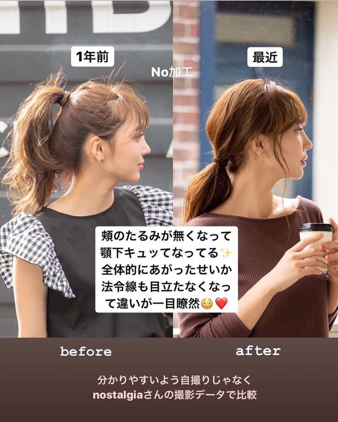 岡部あゆみさんのインスタグラム写真 - (岡部あゆみInstagram)「. . 最近 顔がすっきりしたね って色んな方に言われて HIFUの効果を実感中🥰 よく聞かれるクリニック名は "表参道スキンクリニック @omotesando_skinclinic "です✨ お肌のことはこちらにお任せしています。色んなクリニックでレーザー系をやってきましたが、ここが一番丁寧でしっかり当ててくれる気がする! 今回は笑気麻酔をしながら強い出力で当てたので かなり効果を実感しています◎ レーザー系は簡単そうに見えて 執刀医の腕で効き目が全く違う。クリニック選びにお悩みの方は是非^ ^ . #表参道スキンケアクリニック #ハイフ #HIFU #ソノクイーン #ウルトラセル #ウルセラ #リフトアップレーザー #美容 #リフトアップ #アンチエイジング #ワンピース #ケイトスペード #六本木けやき坂 #夏コーデ #どこでもすぐ休憩 #お出掛け」8月19日 21時47分 - ayumi_okabe