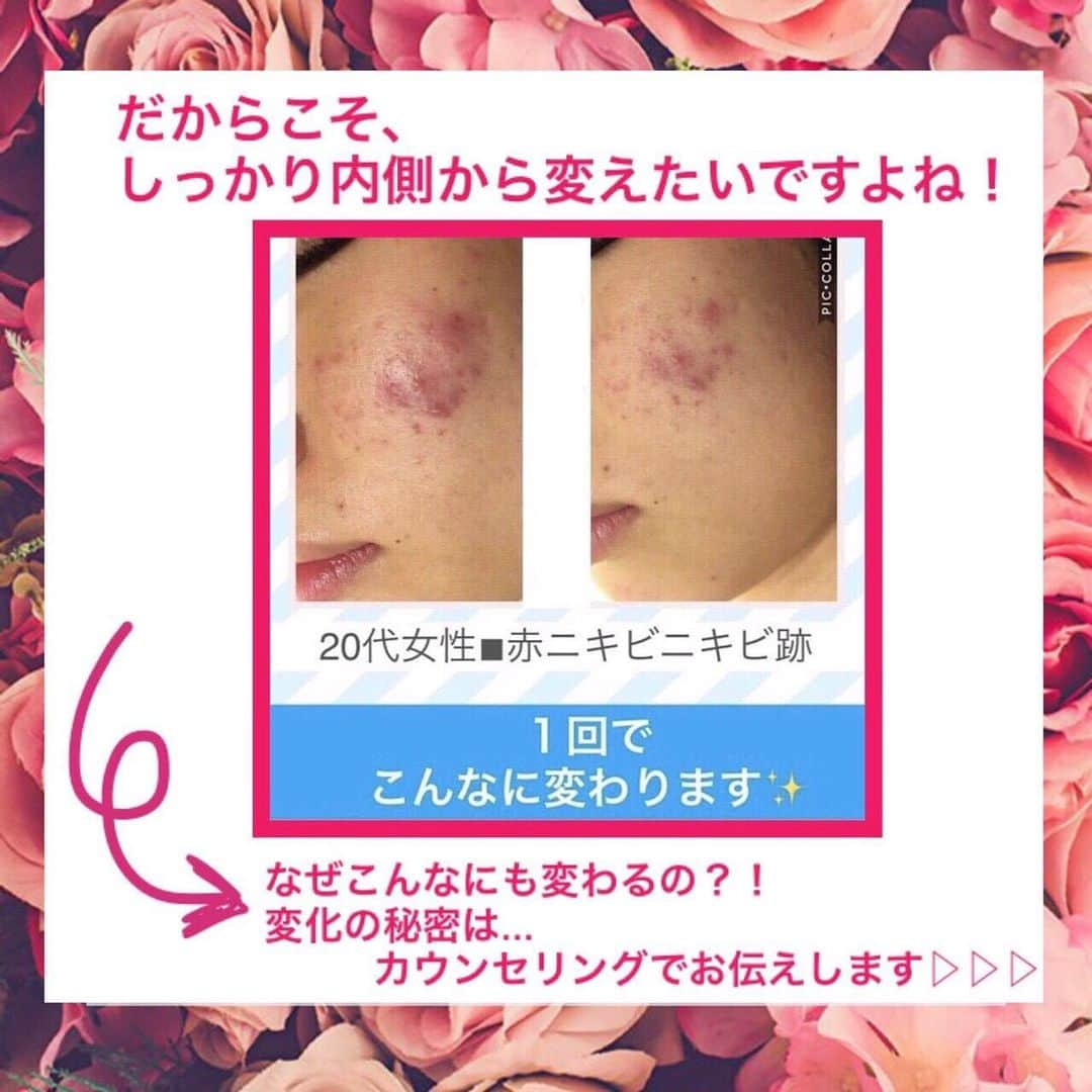 肌質改善専門サロン~Accueil~さんのインスタグラム写真 - (肌質改善専門サロン~Accueil~Instagram)「💙💚❤️8/21 空きあり* * 【ご予約はこちら👇🏼】 🌟🌟 @accueil_ikebukuro 🌟🌟 . ※今だけ期間限定クーポンあり . . . 肌荒れの原因は人それぞれなのにも関わらず、 周りの人と同じケアをしていませんか💦？？ * ❌お薬を塗っても飲んでも変わらない、、 ❌食事を気にしても肌が荒れる、、 ❌スキンケアを変えてもイマイチ、、 ❌何かしら常にトラブルが肌にある、、 ❌ニキビが繰り返しできる、、 * * そのお悩み解決できちゃいます😌✨ Accueilは、どのサロンに行っても良くならなかったお客さまたちや、 どの皮膚科に行っても変化がなかったお客さまたちが多く訪れてくださっています🙌💕* * * * もう悩まない！！！ 繰り返さないところまでしっかりと根本改善していきます☺️ そろそろ肌荒れから卒業しませんか？ * →→→初回体験はこちらから👉🏼 @accueil_ikebukuro * * * * Accueilでのお手当は、、 * 機械は一切使いません🙅‍♀️❌ 使うお化粧品は １００％天然の「ミネルヴァ化粧品」🌲🍃 ニキビの炎症がある方・アトピーの方でも 安心して受けていただける事ができる お肌にとても優しいエステです♡♡ * * お肌のお悩みなら、何でもお任せください😊💕 * * ■「インスタ見ました！」 で、 初回体験￥26,000 →→✨￥５，９８０✨ (お背中の場合はプラス1,000円です) * * * --------当サロンのご予約方法≫--------- *  1️⃣当サロンのインスタTopのURL ⭐『Hotpepper Beauty』の 「instagram限定クーポン」にてご予約可能♡♡ * * 2️⃣インスタのDMからご予約 （下記項目を記載の上、お問い合わせください♪） * 🔶お名前（フルネーム） * 🔶お電話番号 * 🔶希望日時（第１～第３希望） * 🔶ご希望のメニュー * * 3️⃣お電話でのご予約✨ 　03-6912-5705にお願いします♡ ----------------------------------------- * * @accueil_ikebukuro ✨ #ニキビ #ニキビ跡 #毛穴 #乾燥肌 #ニキビ跡ケア #肌荒れ #ニキビ跡改善 #ニキビ肌改善 #ニキビ治療 #保湿 #毛穴の黒ずみ #毛穴の開き #スキンケア #毛穴吸引 #アトピー女子 #ニキビ皮膚科  #美肌ケア  #ニキビ専門 #肌質改善 #背中ニキビ #アトピー肌 #乾燥 #ニキビケア #毛穴ケア #アトピー治療 #肌悩み #スキンケア難民 #肌トラブル改善 #スキンケア大事 #目指せ美肌」8月20日 18時09分 - accueil_ikebukuro