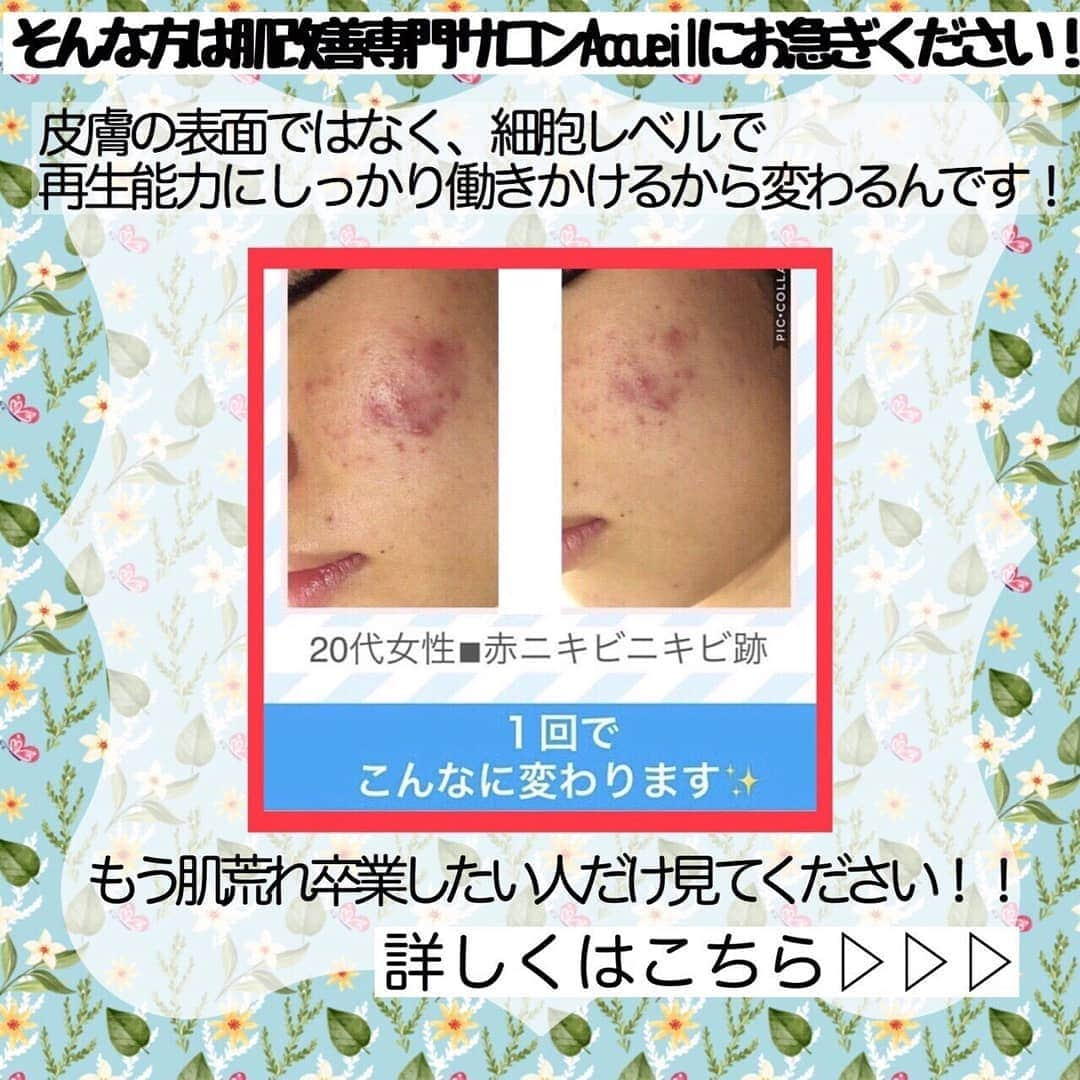 肌質改善専門サロン~Accueil~さんのインスタグラム写真 - (肌質改善専門サロン~Accueil~Instagram)「💙💚22日空きあり💛💜❤ * * 【ご予約はこちら👇🏼】 🌟🌟 @accueil_ikebukuro 🌟🌟 . ※今だけ期間限定クーポンあり . . . 肌荒れの原因は人それぞれなのにも関わらず、 周りの人と同じケアをしていませんか💦？？ * ❌お薬を塗っても飲んでも変わらない、、 ❌食事を気にしても肌が荒れる、、 ❌スキンケアを変えてもイマイチ、、 ❌何かしら常にトラブルが肌にある、、 ❌ニキビが繰り返しできる、、 * * そのお悩み解決できちゃいます😌✨ Accueilは、どのサロンに行っても良くならなかったお客さまたちや、 どの皮膚科に行っても変化がなかったお客さまたちが多く訪れてくださっています🙌💕* * * * もう悩まない！！！ 繰り返さないところまでしっかりと根本改善していきます☺️ そろそろ肌荒れから卒業しませんか？ * →→→初回体験はこちらから👉🏼 @accueil_ikebukuro * * * * Accueilでのお手当は、、 * 機械は一切使いません🙅‍♀️❌ 使うお化粧品は １００％天然の「ミネルヴァ化粧品」🌲🍃 ニキビの炎症がある方・アトピーの方でも 安心して受けていただける事ができる お肌にとても優しいエステです♡♡ * * お肌のお悩みなら、何でもお任せください😊💕 * * ■「インスタ見ました！」 で、 初回体験￥26,000 →→✨￥５，９８０✨ * * * --------当サロンのご予約方法≫--------- *  1️⃣当サロンのインスタTopのURL ⭐『Hotpepper Beauty』の 「instagram限定クーポン」にてご予約可能♡♡ * * 2️⃣インスタのDMからご予約 （下記項目を記載の上、お問い合わせください♪） * 🔶お名前（フルネーム） * 🔶お電話番号 * 🔶希望日時（第１～第３希望） * 🔶ご希望のメニュー * * 3️⃣お電話でのご予約✨ 　03-6912-5705にお願いします♡ ----------------------------------------- * * @accueil_ikebukuro ✨ #ニキビ #ニキビ跡 #毛穴 #乾燥肌 #ニキビ跡ケア #肌荒れ #ニキビ跡改善 #ニキビ肌改善 #ニキビ治療 #保湿 #毛穴の黒ずみ #毛穴の開き #スキンケア #毛穴吸引 #アトピー女子 #ニキビ皮膚科  #美肌ケア  #ニキビ専門 #肌質改善 #背中ニキビ #アトピー肌 #乾燥 #ニキビケア #毛穴ケア #アトピー治療 #肌悩み #スキンケア難民 #肌トラブル改善 #スキンケア大事 #目指せ美肌」8月21日 19時59分 - accueil_ikebukuro