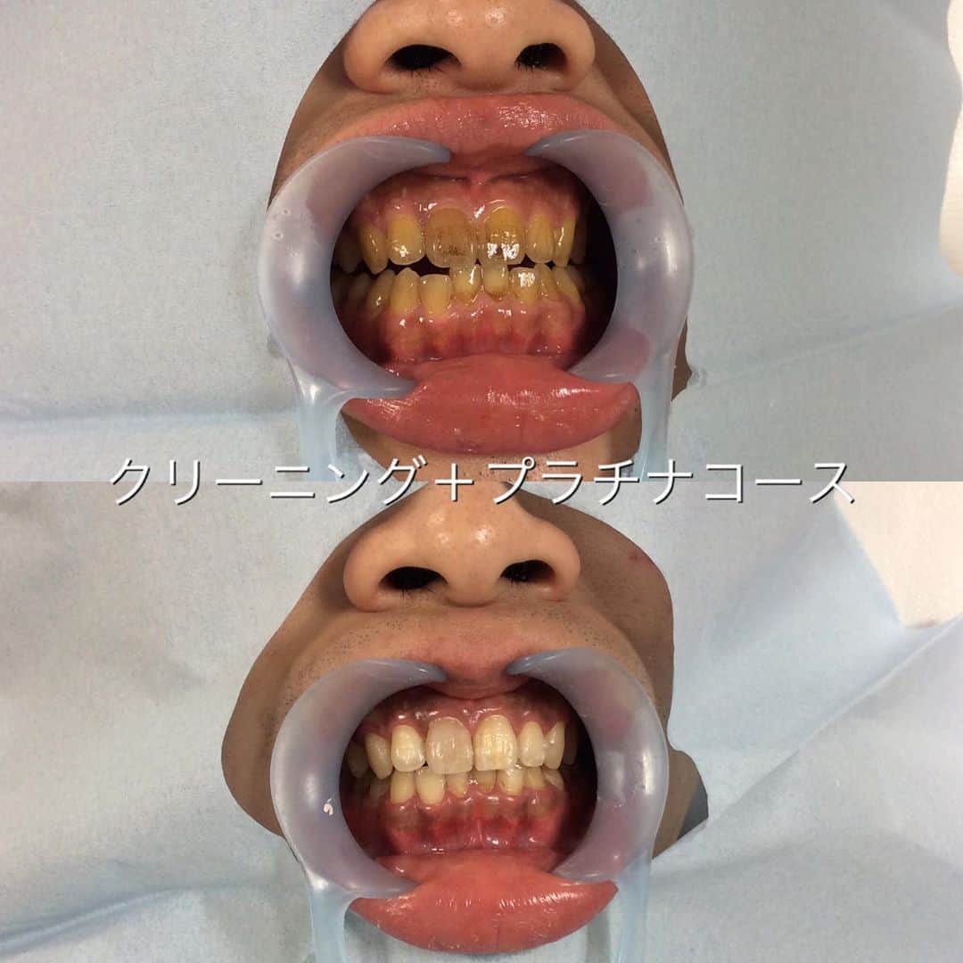 のインスタグラム：「* もしかしたら人生観変わるかもしれない。。 それくらい短時間で口元の印象を変えられるので #メンズ にも #ホワイトニング は絶対オススメ！ * * 子供の頃から歯の色が気になる人でも 他の歯医者さんで「白くできません！」と言われた人も とりあえずまずは相談しに来てください。 * * 今回の方はクリーニング＋45分間のホワイトニング 1回目のbefore/afterです。 #きれいになりたい  その願い叶えます✌🏻🦷👄 * * #勇気を出して来てみてください #変わりたい人 #オフィスホワイトニング #人生 #見た目も大事 #自分磨き #男性美容 #ホワイトニング渋谷 #ホワイトニング銀座 #帰りは笑顔 #綺麗な自分になる #前撮り #挙式 #ブライダル #白い歯 #ホワイトニング口コミ #ホワイトニング評判 #安全なホワイトニング #医療ホワイトニング #女医が担当 #ファッション #ヘアメイク #ネイル #素材磨き」