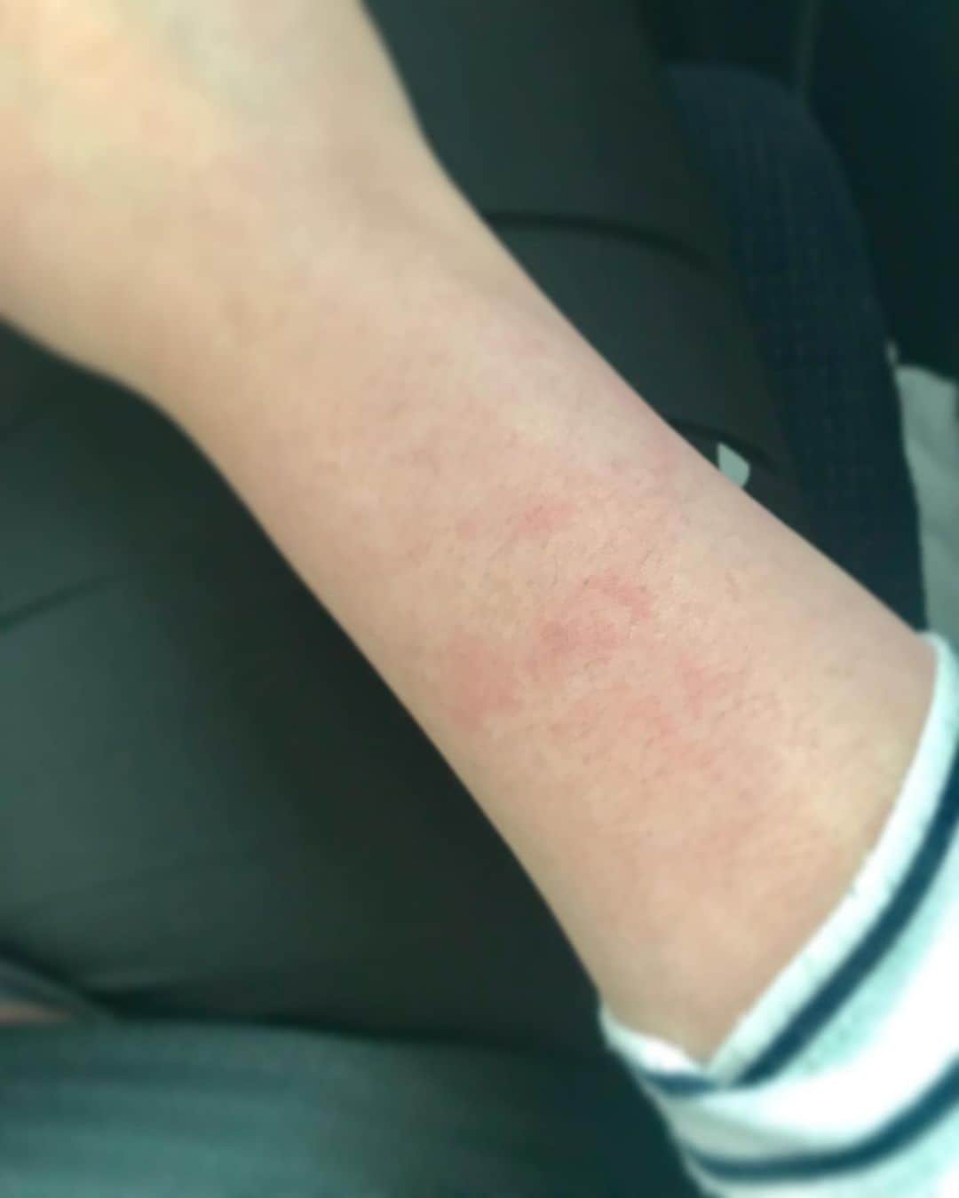 岡村咲さんのインスタグラム写真 - (岡村咲Instagram)「あーーーーーー。 もうーーーーー。 昨日車の後部座席で暑くて夕方やし、と思って気を抜いて半袖になったら今更火傷みたいな痛みが😭💔特に右腕💔肘の辺りまで真っ赤です。。薬塗ります。無理しません。自分にごめんなさい。#sle #全身性エリテマトーデス #油断禁物 #自分に厳しく #自分を大切に」8月23日 16時45分 - sakiokamura_official