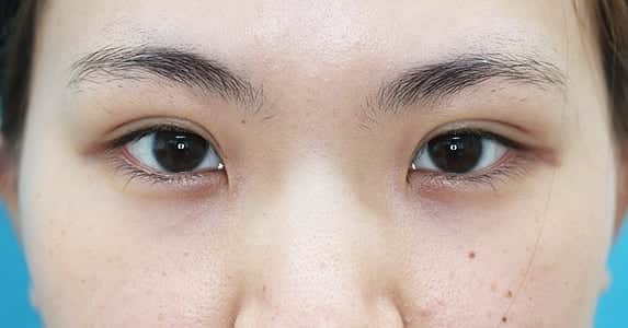 ミライ美デザイン｜大塚美容形成外科・歯科さんのインスタグラム写真 - (ミライ美デザイン｜大塚美容形成外科・歯科Instagram)「#つり目 の原因とは・・・・？ . . ドクター石井のドクターズＢＯＬＧ更新🌠 https://www.otsuka-biyo.co.jp/blog/eye/5549/. . . . つり目とは目尻が上がっている目の形です。. . 目の外側には外視靭帯という靭帯があり、目を固定しています。 この靭帯が上向きに付いていると目尻が上がるため「つり目」になります。 . つり目だと「きつい顔」という印象が強くなります。 . このモニターさんについては  つり目  一重まぶた  厚いまぶた  蒙古ヒダが強い  眉毛が上がっている . という状況が混在しているため、より一層「きつい顔」の印象となっています。. . . . 続きはこちら⇒ https://www.otsuka-biyo.co.jp/blog/eye/5549/ . . . #大塚美容形成外科  #美容形成外科  #形成外科  #整形  #整形外科  #モニター  #モニター募集  #モニターモデル募集  #Kawaii  #cosmeticsurgery  #beauty  #整形したい  #美容好きな人と繋がりたい  #整形垢  #整形垢さんと繋がりたい  #美容垢  #整形しました  #術後経過  #整形経過  #ぱっちり #二重 #二重になりたい #埋没法 #二重埋没法 #二重埋没 #並行二重 #二重整形 #二重整形経過 #二重経過用アカウント」8月27日 11時58分 - otsukabiyo