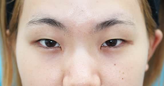 ミライ美デザイン｜大塚美容形成外科・歯科さんのインスタグラム写真 - (ミライ美デザイン｜大塚美容形成外科・歯科Instagram)「#つり目 の原因とは・・・・？ . . ドクター石井のドクターズＢＯＬＧ更新🌠 https://www.otsuka-biyo.co.jp/blog/eye/5549/. . . . つり目とは目尻が上がっている目の形です。. . 目の外側には外視靭帯という靭帯があり、目を固定しています。 この靭帯が上向きに付いていると目尻が上がるため「つり目」になります。 . つり目だと「きつい顔」という印象が強くなります。 . このモニターさんについては  つり目  一重まぶた  厚いまぶた  蒙古ヒダが強い  眉毛が上がっている . という状況が混在しているため、より一層「きつい顔」の印象となっています。. . . . 続きはこちら⇒ https://www.otsuka-biyo.co.jp/blog/eye/5549/ . . . #大塚美容形成外科  #美容形成外科  #形成外科  #整形  #整形外科  #モニター  #モニター募集  #モニターモデル募集  #Kawaii  #cosmeticsurgery  #beauty  #整形したい  #美容好きな人と繋がりたい  #整形垢  #整形垢さんと繋がりたい  #美容垢  #整形しました  #術後経過  #整形経過  #ぱっちり #二重 #二重になりたい #埋没法 #二重埋没法 #二重埋没 #並行二重 #二重整形 #二重整形経過 #二重経過用アカウント」8月27日 11時58分 - otsukabiyo