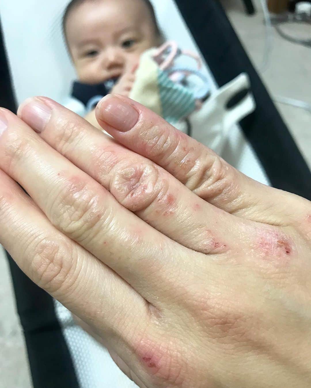 輝良まさとさんのインスタグラム写真 輝良まさとinstagram そう言えば お見苦しいもんをお見せして申し訳ないのですが 最近 主婦湿疹 手荒れ がひどいんです 今年の冬ぐらにから前兆はあったので皮膚科に行ってステロイドをもらったのですが 真那