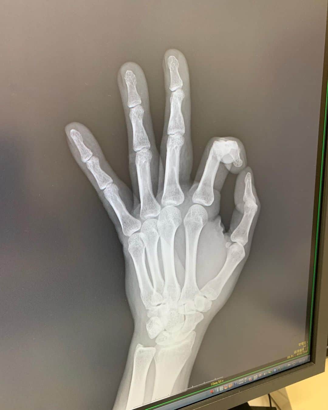 藤沢文翁さんのインスタグラム写真 - (藤沢文翁Instagram)「‪僕の手の骨（笑）異常なしw  腱鞘炎ではなく、サンドバッグ打った時に腱が脱臼したみたい！今後は軽いパンチにする！‬」9月6日 10時21分 - fujisawabun_o