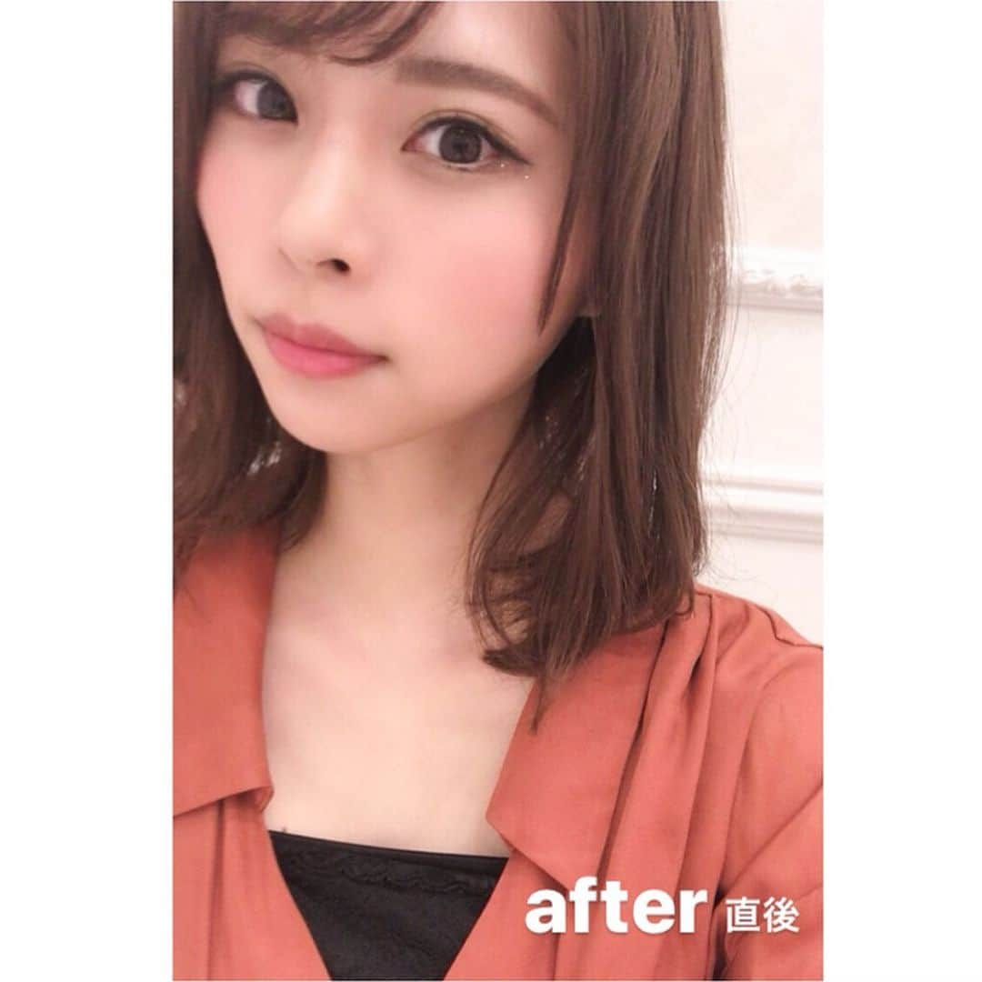 山本成美さんのインスタグラム写真 - (山本成美Instagram)「. 先週@a_clinic_ginza で佐藤先生に @dr.sato_reiji  Aスレッドっていう小顔治療してもらってきた〜😆 インスタでよく見かけるからずっと気になってたの👀✨ . . 切ったり縫ったりしないのに 直後から小顔効果実感 今日で一週間経つけどフェイスライン しっかり上がってる😍!! 目に見える効果がこんなにあると嬉しいいい❤️ . .  #beauty #beautystagram #me #aスレッド #小顔aスレッド #aclinic #aclinic銀座#aクリニック #エークリニック #美容 #小顔 #美肌#リフトアップ #美容外科 #美容皮膚科 #美容クリニック#山田哲雄 #柴田貴志 #佐藤玲史 #谷口弘樹#山崎香名 #小松塁」9月12日 11時24分 - narumi_vivi