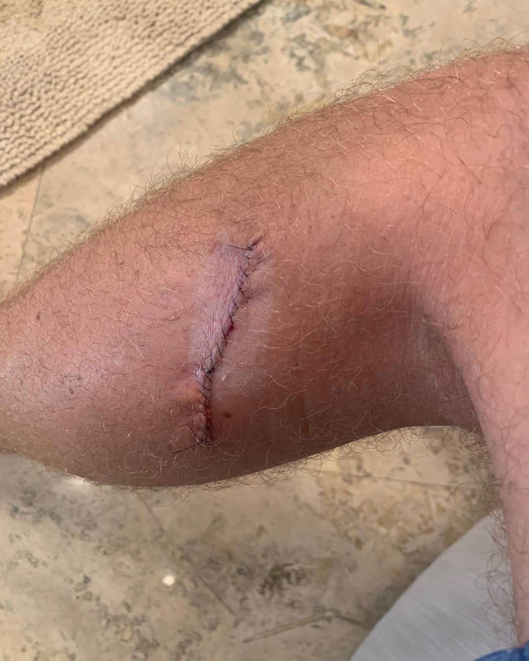 ジャスティン・トーマスのインスタグラム：「I recently had a scare at the dermatologist where a very small mole on my left leg was caught in the early stages of melanoma. Luckily, we found it at a time where there should be no problems going forward. That being said, EVERYBODY GO GET CHECKED!! No harm can come from it and it’s the best way to catch anything before it becomes a serious issue. Especially for all the junior golfers (and other athletes) spending so much time in the sun. It is so important to make sure you’re monitoring your body - no matter how old you are or how much sunscreen you use. It really got my attention, and hoping it does the same to y’all!」