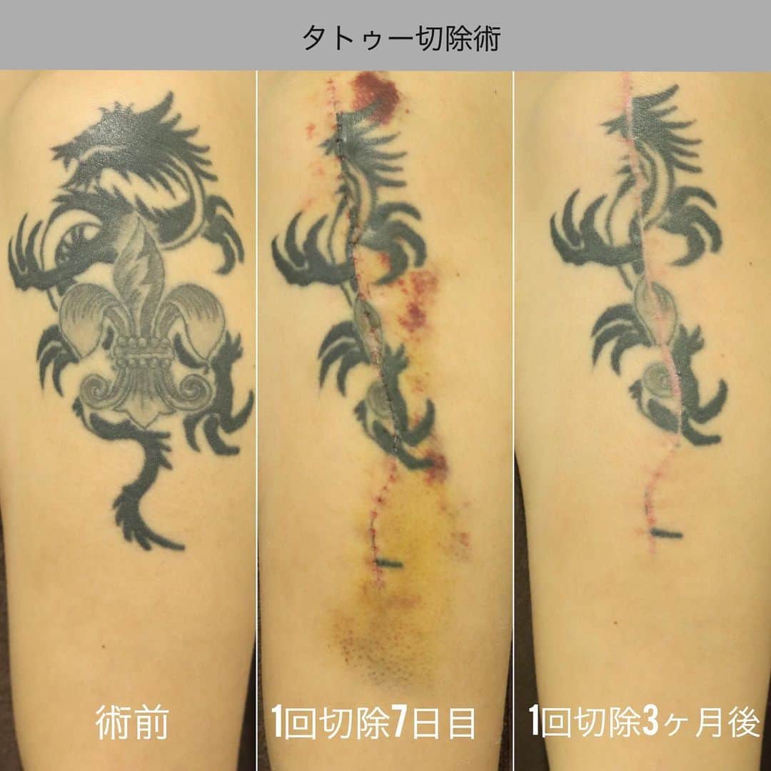 東京イセアクリニックさんのインスタグラム写真 - (東京イセアクリニックInstagram)「タトゥーの切除術 🙅🏻🙅🏻‍♂️ . 肩に入ったタトゥーをなるべく小さな傷での除去を 希望された患者様🗣🗣 ↓↓↓↓↓ 担当医師:ヨシタネ  @yoshitane_isea . 他院では切除は難しい為、 植皮をオススメされたという事でした💉 植皮は 🌟タトゥーが元々あった場所に火傷跡の様な傷跡 🌟皮膚を採取した部分にも傷跡 が出来てしまう為、切除術で除去しました👨🏻‍⚕️👩🏻‍⚕️️ . 写真左:before 写真中央:after 7日目 写真右:after  3ヶ月 7日目〜14日目の間で抜糸となります🌟 皮膚の伸び具合にもよりますが、1回目の切除から3ヶ月後で2回目の切除が可能です👩‍⚕️👨‍⚕️✂︎ . 👛タトゥーサイズ17×10cm¥544000〜 (サイズによって料金は変わります) . 😖麻酔の痛み →痛みが心配な方は笑気麻酔が使用出来ます🌟 ⚠️創部に鈍い痛み:1-2週間程度 ⚠️傷の赤み・引きつれ:3-6ヶ月 🌻テープ保護:3-6ヶ月 →綺麗な傷跡にする為にテープ保護が必要になります🌟 . . タトゥーを消すには理由が各々😖💦 患者さまのニーズに合わせた治療法を 提案いたします💁🏼‍♀️💁🏼‍♂️ . *他院で断られたけど消したい *傷跡を残さずにタトゥーを消したい *就職までにタトゥーを消したい *ダウンタイムなく安く消したい . LINEでもカウンセリングを承っております💌 お気軽にお問い合わせ下さい👩🏻‍⚕️✨ . #銀座#ginza  #iseaclinic#イセアクリニック #美容整形#美容外科#美容皮膚科  #吉種克之 #タトゥー#刺青#刺青除去#タトゥー除去#tattoo #タトゥー女子#切除 #切除術 #植皮 #ピコ#ピコレーザー#picoway#モニター募集 #LINEカウンセリング#カウンセリング無料 #綺麗になりたい#可愛くなりたい」9月16日 11時33分 - iseaclinic