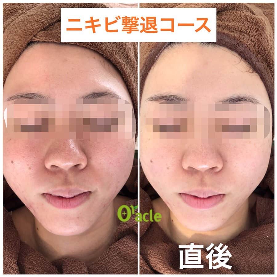 オラクル美容皮膚科東京新宿院さんのインスタグラム写真 - (オラクル美容皮膚科東京新宿院Instagram)「本日よりスタート‼️﻿ ﻿ 古市院長が神推しの『メソナJ』﻿ いよいよ導入⤴︎﻿ ﻿ 新しい手法で大量の美容成分をお肌に導入します✨﻿ ﻿ ▪️▫️▪️▫️▪️▫️▪️▫️▪️▫️﻿ ﻿ 痛みなし👌﻿ ダウンタイムもなし👌﻿ ﻿ 今までの導入治療ではできなかった、幹細胞、ヒアルロン酸、コエンザイムQ10、ビタミンA誘導体などの高分子の美容成分を大量かつ同時にお肌に導入できるのが『メソナJ』🥰😍🥰﻿ ﻿ ▪️▫️▪️▫️▪️▫️▪️▫️▪️▫️﻿ ﻿ 首や背中にもGOOD👍﻿ ﻿ 特別な日の前にもGOOD👍﻿ ﻿ 挙式前や前撮り前にもGOOD👍﻿ ﻿ お買い物、お仕事の合間でもGOOD👍﻿ ﻿ ▪️▫️▪️▫️▪️▫️▪️▫️▪️▫️﻿ ﻿ オラクルオリジナル﻿ 4つのコースをご用意しました👏﻿ ﻿ ①赤ら顔改善コース﻿ ※赤ら顔、アトピー性皮膚炎、眼下のくま﻿ 顔トライアル 14,400円﻿ ﻿ ②ニキビ撃退コース﻿ ※ニキビ、毛穴﻿ 顔トライアル 20,000円﻿ ﻿ ③美白肌コース﻿ ※肝斑、美白、くすみ、シミ﻿ 顔トライアル 20,800円﻿ ﻿ ④トータルアンチエイジングコース﻿ ※たるみ、アンチエイジング、美白、肝斑、シミ、毛穴﻿ 顔トライアル 24,000円﻿ ﻿ 💎オプションで成分追加は1,000円〜﻿ ﻿ ※上記は税抜き価格となります。﻿ ﻿ ▪️▫️▪️▫️▪️▫️▪️▫️▪️▫️﻿ ﻿ 直後からお肌のトーンが上がり、﻿ お肌が変わるのを実感できます😍﻿ ﻿ ※コースはご来院後に決めていただいても大丈夫です🙆‍♀️﻿ ﻿ ご予約お待ちしております💗﻿ ﻿ ━━━☆・‥…━━━☆﻿ 【オラクル美容皮膚科】﻿ ﻿ ※完全予約制※﻿ ※クリニック不定休※﻿ . ﻿ フリーダイヤル﻿ ☎0120-905-696﻿ 受付時間 9:00～21:00［年中無休］﻿ LINE🆔：@oracle.jp﻿ ﻿ #美容 #美容皮膚科 #エレクトロポレーション #イオン導入 #ヒト幹細胞 #幹細胞 #ニキビ改善 #ニキビ治療 #ヒアルロン酸 #コエンザイムQ10 #赤ら顔 #アンチエイジング #若返り #毛穴 #アトピー改善 #肝斑治療 #シミ治療 #美白 #メソアクティス﻿ ﻿」9月20日 8時57分 - oraclejp