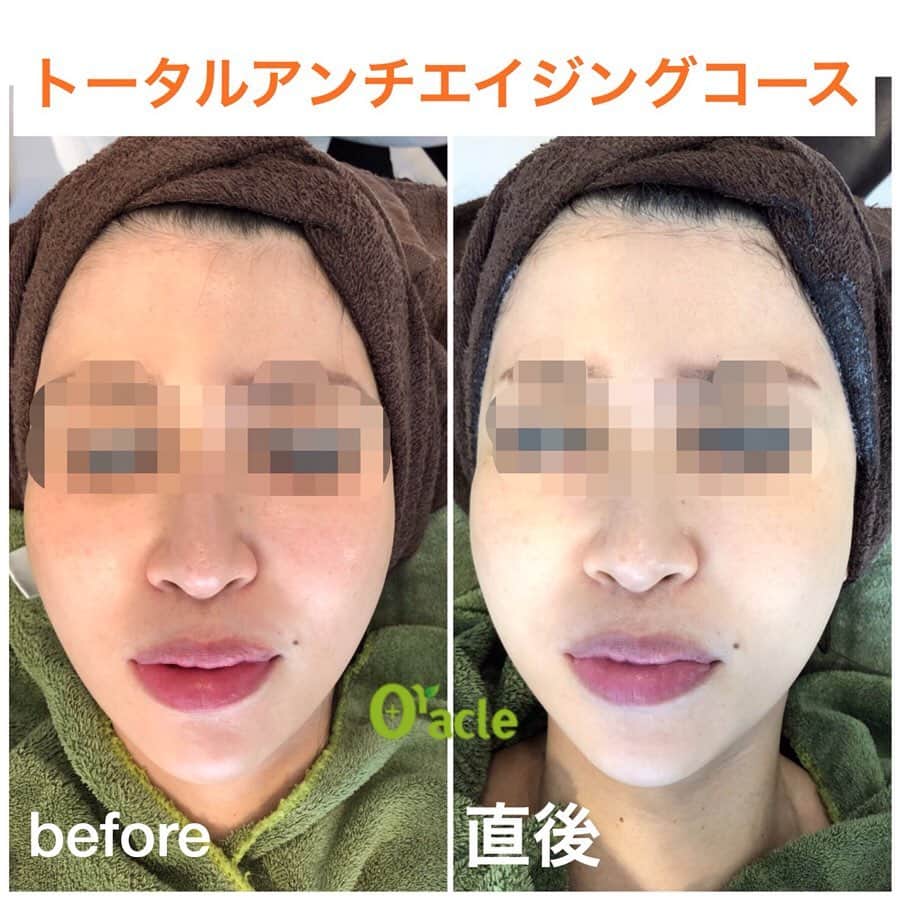 オラクル美容皮膚科東京新宿院さんのインスタグラム写真 - (オラクル美容皮膚科東京新宿院Instagram)「本日よりスタート‼️﻿ ﻿ 古市院長が神推しの『メソナJ』﻿ いよいよ導入⤴︎﻿ ﻿ 新しい手法で大量の美容成分をお肌に導入します✨﻿ ﻿ ▪️▫️▪️▫️▪️▫️▪️▫️▪️▫️﻿ ﻿ 痛みなし👌﻿ ダウンタイムもなし👌﻿ ﻿ 今までの導入治療ではできなかった、幹細胞、ヒアルロン酸、コエンザイムQ10、ビタミンA誘導体などの高分子の美容成分を大量かつ同時にお肌に導入できるのが『メソナJ』🥰😍🥰﻿ ﻿ ▪️▫️▪️▫️▪️▫️▪️▫️▪️▫️﻿ ﻿ 首や背中にもGOOD👍﻿ ﻿ 特別な日の前にもGOOD👍﻿ ﻿ 挙式前や前撮り前にもGOOD👍﻿ ﻿ お買い物、お仕事の合間でもGOOD👍﻿ ﻿ ▪️▫️▪️▫️▪️▫️▪️▫️▪️▫️﻿ ﻿ オラクルオリジナル﻿ 4つのコースをご用意しました👏﻿ ﻿ ①赤ら顔改善コース﻿ ※赤ら顔、アトピー性皮膚炎、眼下のくま﻿ 顔トライアル 14,400円﻿ ﻿ ②ニキビ撃退コース﻿ ※ニキビ、毛穴﻿ 顔トライアル 20,000円﻿ ﻿ ③美白肌コース﻿ ※肝斑、美白、くすみ、シミ﻿ 顔トライアル 20,800円﻿ ﻿ ④トータルアンチエイジングコース﻿ ※たるみ、アンチエイジング、美白、肝斑、シミ、毛穴﻿ 顔トライアル 24,000円﻿ ﻿ 💎オプションで成分追加は1,000円〜﻿ ﻿ ※上記は税抜き価格となります。﻿ ﻿ ▪️▫️▪️▫️▪️▫️▪️▫️▪️▫️﻿ ﻿ 直後からお肌のトーンが上がり、﻿ お肌が変わるのを実感できます😍﻿ ﻿ ※コースはご来院後に決めていただいても大丈夫です🙆‍♀️﻿ ﻿ ご予約お待ちしております💗﻿ ﻿ ━━━☆・‥…━━━☆﻿ 【オラクル美容皮膚科】﻿ ﻿ ※完全予約制※﻿ ※クリニック不定休※﻿ . ﻿ フリーダイヤル﻿ ☎0120-905-696﻿ 受付時間 9:00～21:00［年中無休］﻿ LINE🆔：@oracle.jp﻿ ﻿ #美容 #美容皮膚科 #エレクトロポレーション #イオン導入 #ヒト幹細胞 #幹細胞 #ニキビ改善 #ニキビ治療 #ヒアルロン酸 #コエンザイムQ10 #赤ら顔 #アンチエイジング #若返り #毛穴 #アトピー改善 #肝斑治療 #シミ治療 #美白 #メソアクティス﻿ ﻿」9月20日 8時57分 - oraclejp