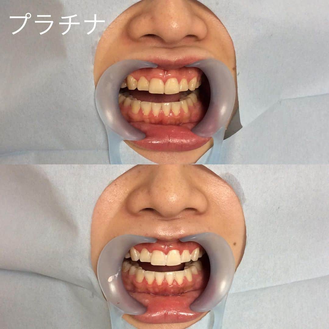 ホワイトニング専門クリニック ホワイトラボ東京 渋谷さんのインスタグラム写真 - (ホワイトニング専門クリニック ホワイトラボ東京 渋谷Instagram)「* プラチナコース 45分1回目のbefore/after写真🤳 今日はホワイトラボ東京 渋谷院の人気メニューをご紹介します❣️ * 〜ホワイトニングメニュー〜 《人気No.1 プラチナコース》 最近ではこちらのコースが人気上昇中です⤴️ 1回でしっかり効果を実感できて色持ちが良く通うのが苦手な方や遠方からの方にも大変ご好評頂いております👩🏼‍⚕️ 多くの方が「ここまで変わるとは思ってなかった😳」と嬉しいお言葉を言って下さいます✨ * 〜オプションメニュー〜 《ステインオフクリーニング》 ホワイトニングの前に細かい汚れや着色を落とすことでホワイトニング効果もUPします‼️ 更に9月はキャンペーンで歯科専売歯ブラシをプレゼントしています🦷 * 定期的なメンテナンスで持続効果も高まります。理想は3.4ヶ月に1度のホワイトニングがオススメです😁 * 最近ではインスタグラムを見て沢山の人が来院して下さいます🙇‍♀️ カウンセリングでしっかりお客様の不安やご希望を聞き1人1人に合ったホワイトニングをします🔥🔥 必ずホワイトラボ東京に来てよかったと思って貰える自信があります💪🏻 * 【渋谷院】 〒150-0002 渋谷区渋谷1-14-14植村会館ビル7階 ☎︎03-6805-1240 【銀座院】 〒104-0061 中央区銀座6-4-7G.O.west ビル8階 ☎︎03-6875-4545  #ホワイトラボ東京 #驚きの白さ #自然な仕上がり #医療ホワイトニング #オフィスホワイトニング #ホワイトニング渋谷 #ホワイトニング銀座 #安全安心 #口コミで広がる #芸能人も通う #来院しやすい雰囲気 #接客が良い #丁寧な説明 #価格が適正 #メニューが豊富 #立地が良い #歯科医師が行うホワイトニング #専門知識 #歯科知識 #1人1人に合った #ホワイトニング #歯の質によって違う #ホワイトニング選び重要 #カウンセリング無料 #トレーニング #口元の印象 #綺麗な歯 #大事 #歯磨き粉 #歯ブラシ」9月21日 9時51分 - whitelabtokyo