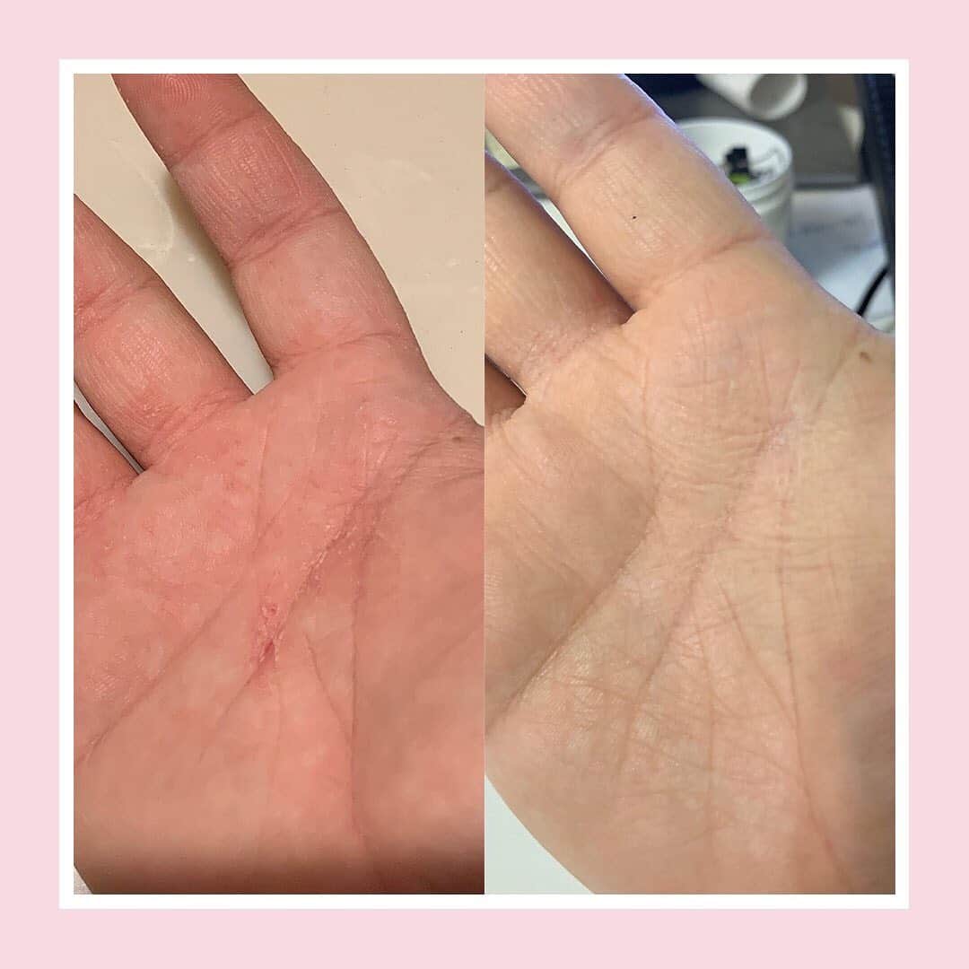 KORA Organicsさんのインスタグラム写真 - (KORA OrganicsInstagram)「Our #myKORA Testimonials page is now live and we couldn't be more excited to share how KORA has helped people like Miriam transform their skin. 💖 Swipe left for Miriam's eczema before and after and visit our link in bio for more #SkinTransformations. ✨ #KORAOrganics #mindbodyskin」9月21日 2時20分 - koraorganics