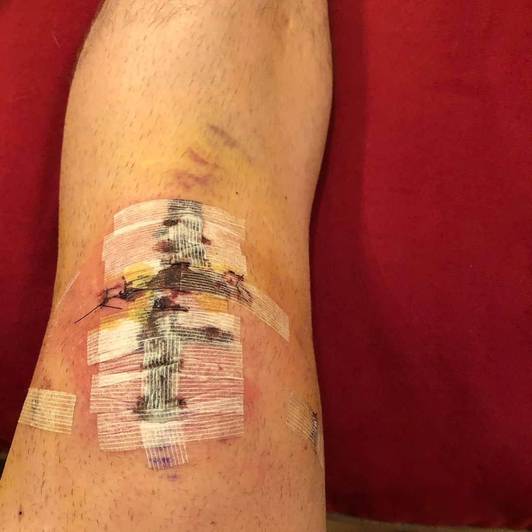 ネイサン・バーソロメイのインスタグラム：「So I’ve been getting so many messages from my friends and supporters wondering what I’ve been up to and how things are going. Here goes!  On May 15th of this year I underwent a full patellar tendon repair where they removed some of the damaged tendon as well as some abnormalities from under my knee cap which was causing the issue. This injury had me skating in pain through most of the 2017 and 2018 seasons and I was constantly in therapy and struggling to recover. After trying injections and different medication and PT I had exhausted all of my options and this is when my team and I made the decision to turn to surgery.  I would like to take this opportunity to thank my coaches @jpcoach and @acevora84 as well as @bodybybarb or you unwavering support durning this difficult time in my life. As well as @pt_solutions and @floridamedicalcliniccareers for your patience and hard work to get me back on my feet! I would also like to thank all of my family and friends (specifically my mom @annmbartholomay ) for cooking and cleaning and taking care of me for a few weeks! Lastly I would like to thank my fans and supporters for being there!  I am scheduled to make a 100% full recovery and then I plan to evaluate myself and decide next season for me as a #TeamUSA athlete!  More updates soon! But keep your eyes out because I’ll be back 💪🏼」