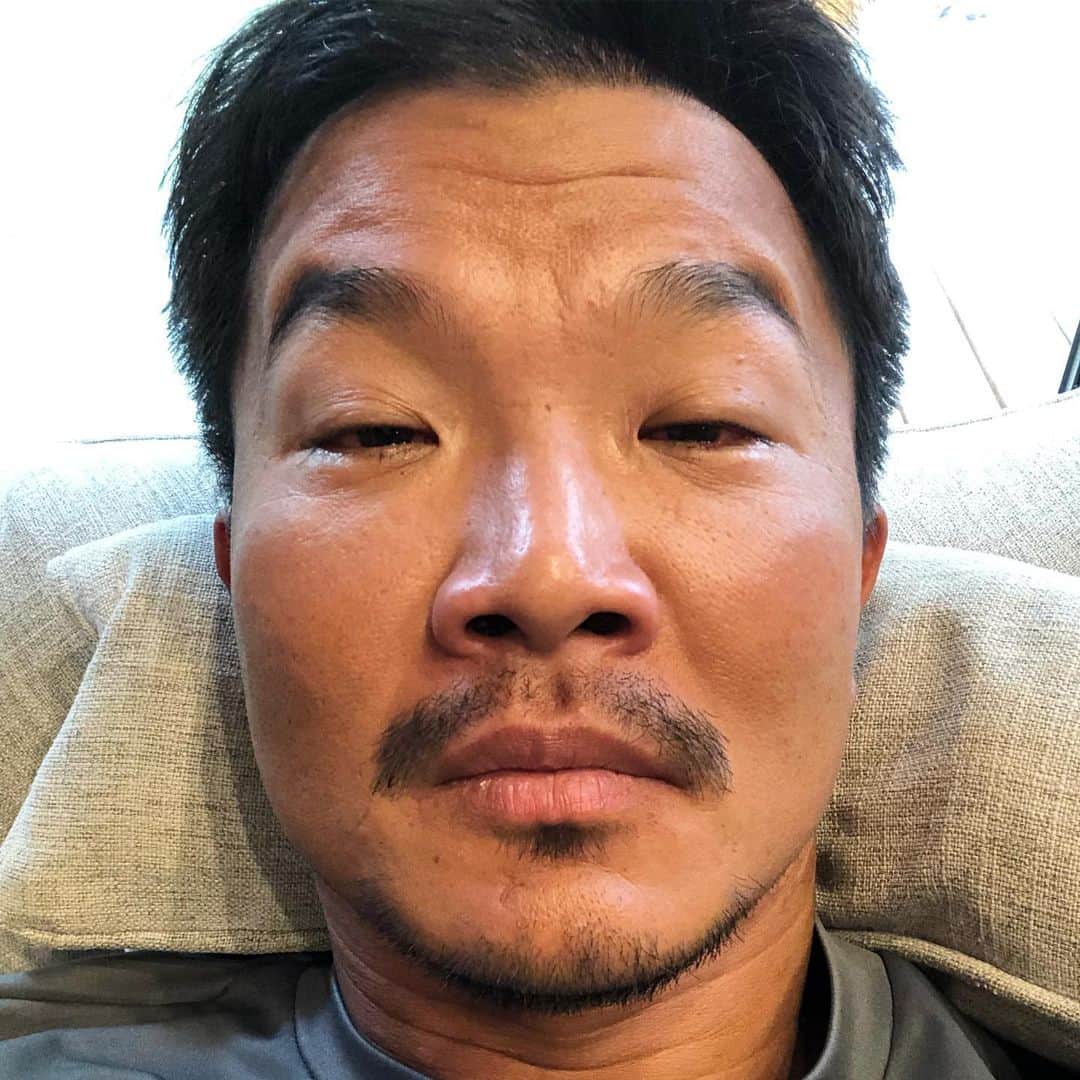 大西宏明さんのインスタグラム写真 - (大西宏明Instagram)「元々ブスやけど…この2週間 超絶ブスになってました😂😭😂😭 やっと復活✨✨✨✨ #殴られた #酔っ払い顔 #二日酔い  #そんなんちゃいます #結膜炎 ですわ #娘 のやつうつされましてん #ナメてた #エグい #元々やけど #目開けへん #視界ゼロ #超絶ブス #最悪な2週間 #もれなく #息子 #嫁 #全員 #結膜炎家族 #一家団欒眼科 #やっと復活 #見えるって幸せ #ブス写真ですみません #smile #ほなっ！！」9月24日 0時39分 - ohnishi_hiroaki_0428