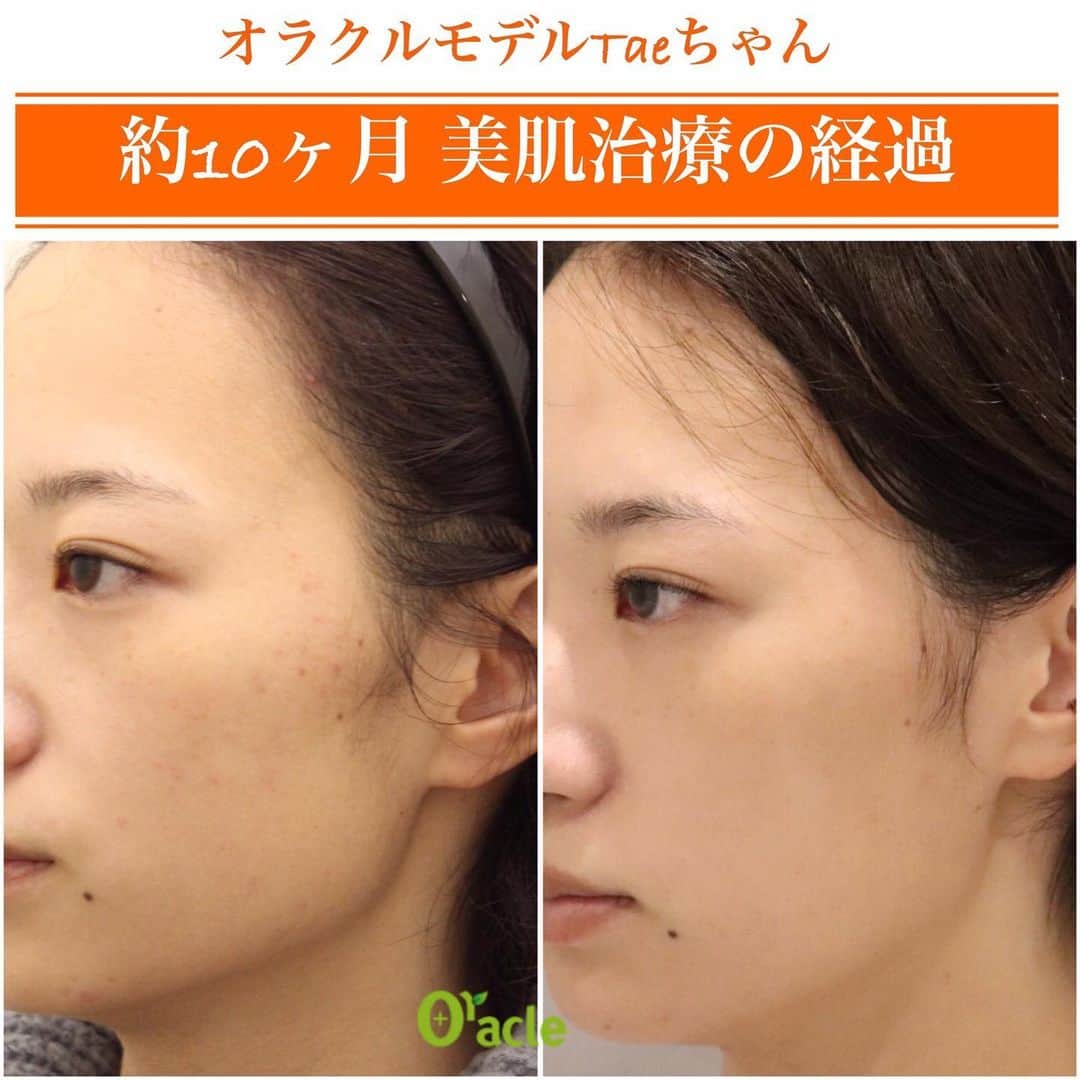 オラクル美容皮膚科東京新宿院さんのインスタグラム写真 - (オラクル美容皮膚科東京新宿院Instagram)「オラクルモデルTaeちゃん💚﻿ @taechan_72  オラクルのモデルになって約一年💚﻿ ﻿ 約月に1回、美肌治療を行ってきました✨﻿ ﻿ swipe➡︎ 2枚目ニキビ改善﻿ ﻿ 最初の頃の写真(10ヶ月前）と比べると﻿ ニキビがなくなり👏﻿ トーンアップし⤴️﻿ ﻿ くすみがなく、艶のある理想的なお肌になりました👏👏👏﻿ ﻿ ▪️▫️▪️▫️▪️▫️▪️▫️▪️▫️﻿ ﻿ Taeちゃんはフェイスラインのニキビができやすいお肌で、今でも体調によっては出来てしまうこともあるそうですが、以前よりは出来にくくなったそうです👏﻿ ﻿ ▪️▫️▪️▫️▪️▫️▪️▫️▪️▫️﻿ ﻿ 今までに受けた治療です💚﻿ 今度Taeちゃんに特にどの施術が良かったか、お肌に合っていたか聞いてみたいと思います。﻿ 水光注射はお気に入りみたいです💚﻿ ﻿ #クリスタル水光注射﻿ #アクアピーリング﻿ #ピコトーニング﻿ #雪玉水光注射﻿ #トックスピール﻿ #コラーゲンピール﻿ #ルメッカ﻿ #ハイドラフェイシャル﻿ #夏玉水光注射﻿ #ミルクピーリング﻿ #メソナJ（ニキビ撃退コース）﻿ ﻿ ニキビができやすい体質の方はぜひ参考にしてみてください。﻿ ﻿ ▪️▫️▪️▫️▪️▫️▪️▫️▪️▫️﻿ ﻿ 🇯🇵オラクル美容皮膚科🇰🇷﻿ 📍新宿3丁目19-4 MLJ新宿8階﻿ ﻿ 【専門】﻿ ニキビ（跡）／毛穴／シミ／しわ／たるみ／痩身／アンチエイジング／美白美肌治療全般／ブライダル相談﻿ ﻿ 🗝完全予約制﻿ 👠土日祝日も診療﻿ ﻿ 【予約方法】﻿ ☎0120-905-696﻿ ⏰9:00～21:00［年中無休］﻿ ﻿ LINE、メール24時間📧﻿ LINE🆔 @oracle.jp ﻿ 📩HPメールフォームよりお願いいたします﻿ ﻿ ▪️▫️▪️▫️▪️▫️▪️▫️▪️▫️﻿ ﻿ #美容 #美容皮膚科 #ニキビ治療  #アンチエイジング  #毛穴 美白ケア #美容オタク #美容マニア #美容マニア御用達 #美容好きな人と繋がりたい #美容好き #美容好きさんと繋がりたい」10月22日 10時19分 - oraclejp
