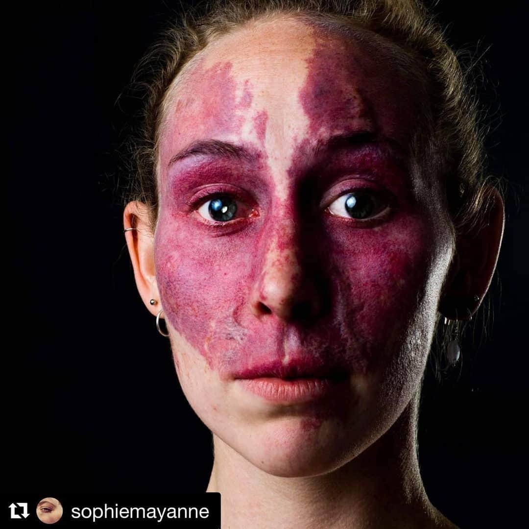 アマンダ・サイフリッドさんのインスタグラム写真 - (アマンダ・サイフリッドInstagram)「#wcw : @sophiemayanne who shines her light on other glorious beings like @tofacetheworld ・・・#repost #behindthescars "My name is Tessa. I was born with Sturge Weber Syndrome, with a port wine birthmark covering the whole of my face.  When I was just born the doctors advised my parents to start with laser treatment. The earlier, the better, they were told – as the skin would react better. And it did, in the beginning. But, when I was two years old, the laser treatment went wrong. The hospital had a new laser machine that turned out to be calibrated 4 times higher than it should have been. This burnt my birthmark, resulting in the scars on my birthmark. From then onwards, my parents decided against laser treatment.  When I was 6, we also found out that my eye was affected by glaucoma, as a result of the Sturge Weber Syndrome. We focused more on my sight, to help keep that steady instead of the birthmark treatment.  I grew up in Amsterdam. My childhood was, besides medical treatment, very relaxed without a lot of trouble. My birthmark was not an issue, and my parents coped really well with it. I was never bullied in school, and, besides some issues with my sight, I could do everything and I was always free to choose what made me happy.  I never covered my birthmark with makeup. I once tried it, but I didn’t recognise myself in the mirror. For me, my sight is so much more important – to be able to see the world. I know I get looks and stares, but I have never really felt bad about that.  The scars on my birthmark fall away in the birthmark. They look like they are part of the birthmark, and that’s why some think I am burnt. Sometimes I think my birthmark would have looked a lot smoother (as in flatter) without the scars, and I wish my parents did not go through the terrible experience of having their child burnt by the same doctors who told them to start the treatment. But, the scars are a part of me and I would not want them gone.  I have a full life, many friends, I love studying, I have amazing parents, a home. Of course, a birthmark challenges certain aspects of my life, but it brings a lot of beautiful things too.” @tofacetheworld」10月24日 1時27分 - mingey