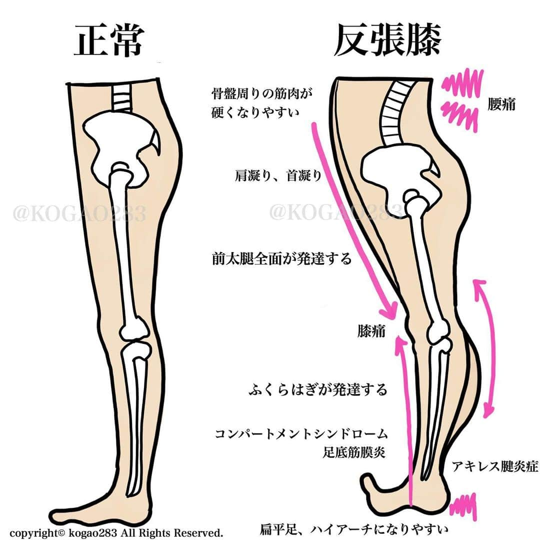 kogao283さんのインスタグラム写真 - (kogao283Instagram)「反張膝 改善 ストレッチ①  反張膝の方は 2枚目の画像の通り身体の不調が多く 特に ふくらはぎ(腓腹筋)の伸びが悪く硬くなってる場合が多いです😭  1枚目のように先ずは 硬くなってしまったふくらはぎのストレッチを行ないましょう☝️ #ストレッチ#脚やせ#美脚#美脚トレーニング」10月5日 19時09分 - kogao283