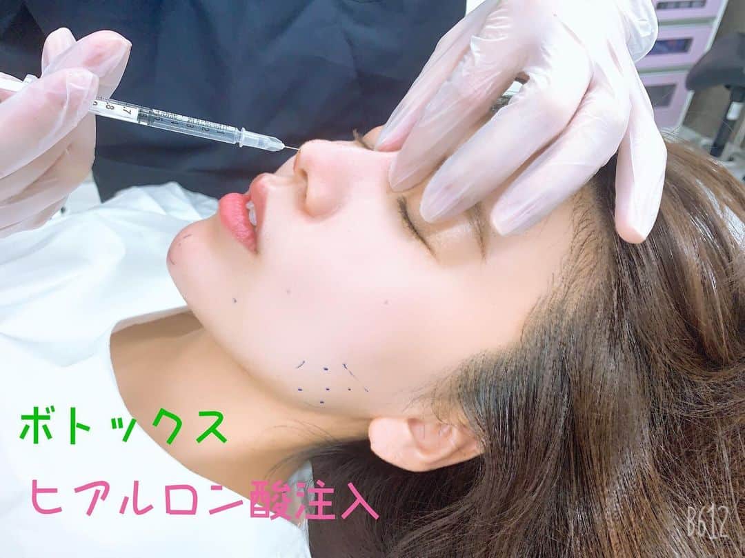 東京美容外科公式さんのインスタグラム写真 - (東京美容外科公式Instagram)「東京美容外科赤坂院です。 スタッフも定期的に受けている治療をご紹介致します。シワの予防に有効的な『ボトックス治療』と、横顔美人を目指しEラインを少し整える為に鼻と顎に『ヒアルロン酸注入』を致しました✨ボトックスは、筋肉の収縮を抑制することで「しわの予防」や、すでに出来てしまった「しわの改善」をすることが出来る注射治療です！20代や30代の、しわが出来きる前からの早めの治療がおすすめです。多くの患者様が1回の注射で効果を実感していただいております✨ヒアルロン酸注入も直後から変化を感じて頂けるので人気があります✨しっかりマーキングしてもらいお注射💉💉お時間もかからない施術ですので、お気軽にご相談下さいませ☺️ ===🎁お問い合わせはこちら🎁==== 詳しくはプロフィールのURLから公式サイトへ♪ ▼フリーダイヤル 0120-658-958 （コールセンター受付時間：9：00～21：00） ▼LINE予約 @ tkc110 #東京美容外科 #東京美容外科赤坂院 #赤坂 #港区#美容 #美容整形 #きれい #整形 #美活 #綺麗になりたい #美肌 #美意識  #美容外科 #プチ整形 #韓国  #エイジングケア #アンチエイジング #美容好き #韓国美容 #美容整形外科 #二重 #埋没法 ===🎁お問い合わせはこちら🎁==== 詳しくはプロフィールのURLから公式サイトへ♪ ▼フリーダイヤル 0120-658-958 （コールセンター受付時間：9：00～21：00） ▼LINE予約 @ tkc110 ========================= #東京美容外科 #東京美容外科赤坂院 #赤坂 #港区#美容 #美容整形 #きれい #整形 #美活 #美肌 #美意識  #美容外科  #エイジングケア #アンチエイジング #美容好き #韓国美容 #美容整形外科 #皺 #しわ #ボトックス #しわ治療 #表情ジワ#ヒアルロン酸#ヒアルロン酸注入」10月7日 12時55分 - tokyobiyougeka_jimukyoku