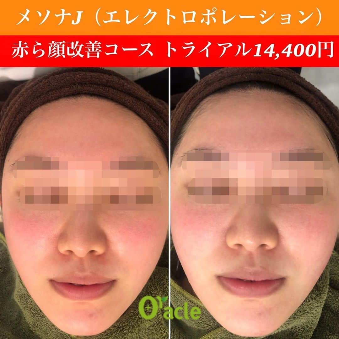 オラクル美容皮膚科東京新宿院さんのインスタグラム写真 - (オラクル美容皮膚科東京新宿院Instagram)「フル稼働中です💦﻿ たくさんのご予約ありがとうございます🙇‍♀️﻿ ﻿ 浸透させます『メソナJ』✨✨✨﻿ （エレクトロポレーション）﻿ ﻿ ▪️▫️▪️▫️▪️▫️▪️▫️▪️▫️﻿ ﻿ 赤ら顔改善コースご紹介❣️﻿ ﻿ メイクで隠すのが難しい赤ら顔、目の下のくま改善に﻿ メソナJなら直後から高い効果が期待でします⤴️﻿ ﻿ 男性でも赤ら顔に悩む方はとても多く、男性はメイクで隠せないので特に気にされる方が多いです😅﻿ ﻿ そんな方にぜひメソナJの赤ら顔改善コースをお試しいただきたいです👆﻿ ﻿ 赤ら顔改善コースは、アトピーの方や目の下クマにも効果的です。﻿ ﻿ ▪️▫️▪️▫️▪️▫️▪️▫️▪️▫️﻿ ﻿ 【メソナJ料金】﻿ 4つのコースをご用意しました👏﻿ ﻿ ①赤ら顔改善コース﻿ ※赤ら顔、アトピー性皮膚炎、眼下のくま﻿ 顔トライアル 14,400円﻿ ﻿ ②ニキビ撃退コース﻿ ※ニキビ、毛穴﻿ 顔トライアル 20,000円﻿ ﻿ ③美白肌コース﻿ ※肝斑、美白、くすみ、シミ﻿ 顔トライアル 20,800円﻿ ﻿ ④トータルアンチエイジングコース﻿ ※たるみ、アンチエイジング、美白、肝斑、シミ、毛穴﻿ 顔トライアル 24,000円﻿ ﻿ 💎オプションで成分追加も1,000円〜﻿ ﻿ ※上記は税抜き価格となります。﻿ ﻿ ▪️▫️▪️▫️▪️▫️▪️▫️▪️▫️ ﻿ ﻿ ﻿ ※コースはご来院後に決めていただいても大丈夫です🙆‍♀️﻿ ﻿ ご予約お待ちしております💗﻿ ﻿ ▪️▫️▪️▫️▪️▫️▪️▫️▪️▫️﻿ ﻿ 🇯🇵オラクル美容皮膚科🇰🇷﻿ 📍新宿3丁目19-4 MLJ新宿8階﻿ ﻿ 【専門】﻿ ニキビ（跡）／毛穴／シミ／しわ／たるみ／痩身／アンチエイジング／美白美肌治療全般﻿ ﻿ 🗝完全予約制﻿ 👠土日祝日も診療﻿ ﻿ 【予約方法】﻿ ☎0120-905-696﻿ ⏰9:00～21:00［年中無休］﻿ ﻿ LINE、メール24時間📧﻿ LINE🆔 @oracle.jp ﻿ 📩HPメールフォームよりお願いいたします﻿ ﻿ ▪️▫️▪️▫️▪️▫️▪️▫️▪️▫️﻿ ﻿ #美容 #美容皮膚科 #エレクトロポレーション #イオン導入 #ヒト幹細胞 #幹細胞 #ニキビ改善 #ニキビ治療 #ヒアルロン酸 #コエンザイムQ10 #赤ら顔 #アンチエイジング #若返り #毛穴 #アトピー改善 #肝斑治療 #シミ治療 #美白ケア #美容オタク #美容マニア #美容マニア御用達 #美容好きな人と繋がりたい #美容好き #美容好きさんと繋がりたい」10月8日 19時07分 - oraclejp