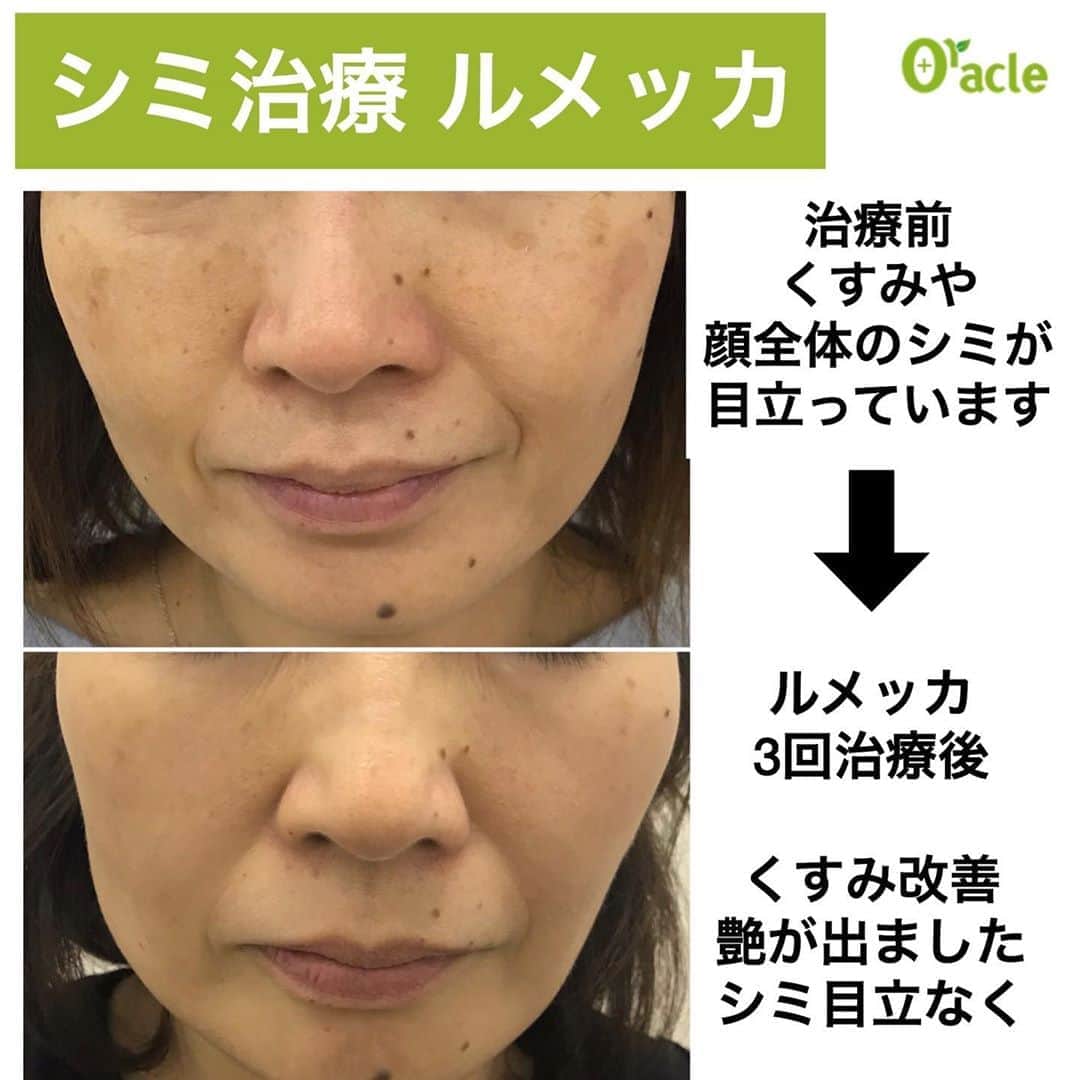 オラクル美容皮膚科東京新宿院さんのインスタグラム写真 - (オラクル美容皮膚科東京新宿院Instagram)「【シミ治療 ルメッカ】﻿ アンチエイジングにもとってもおすすめのフォトフェイシャルです✨﻿ ﻿ 50代女性の治療経過。﻿ ルメッカ とハイドラフェイシャル やコラーゲンピールを組み合わせたコンビ治療です。﻿ ﻿ 治療前は顔全体にシミがあり、お肌もくすんでいました。﻿ ﻿ ▪️▫️▪️▫️▪️▫️▪️▫️▪️▫️﻿ ﻿ ルメッカ 3回治療。﻿ とても効果がよく、﻿ シミもかなり薄くなり、﻿ 薄いシミはほとんどなくなりました👏﻿ ﻿ そして何よりくすみが改善されて✨﻿ お肌は3トーンくらいアップしてる⁈⤴️﻿ ﻿ と、いうくらい艶のある白いお肌に改善されました✨✨✨﻿ ﻿ ▪️▫️▪️▫️▪️▫️▪️▫️▪️▫️﻿ ﻿ お肌のトーンがあがり若々しい印象になりましたね🥰﻿ 見た目年齢は確実にマイナスになっています👍﻿ ﻿ ご本人もとても喜んでおられて、美容にすっかり目覚めて毎月メンテナンスで美肌を維持されています。﻿ ﻿ お友達からもお肌綺麗になったね。﻿ 何したの〜？とたくさん聞かれるそうですよ👌﻿ ﻿ ▪️▫️▪️▫️▪️▫️▪️▫️▪️▫️﻿ ﻿ 【ルメッカ 料金】※税抜﻿ 10月トライアル料金﻿ 部分（頬上部or下部）1回 15,000円﻿ 全顔1回 20,000円﻿ ﻿ ▪️▫️▪️▫️▪️▫️▪️▫️▪️▫️﻿ ﻿ ルメッカ は…﻿ こんなシミ治療をしたい方におすすめ﻿ ﻿ ◇今までのシミ治療で効果がなかった﻿ ﻿ ◇新しいシミ治療を試したい﻿ ﻿ ◇シミ・そばかす・赤ら顔改善したい﻿ ﻿ ◇シミ予防もしたい﻿ ﻿ ◇シミ治療と同時にお肌を綺麗にしたい﻿ ﻿ ▪️▫️▪️▫️▪️▫️▪️▫️▪️▫️﻿ ﻿ アクアピーリングやハイドラフェイシャル、コラーゲンピールなどとのコンビ治療もおすすめです💗﻿ ﻿ お肌全体に艶が出て、毛穴引き締め効果がUPしますよ⤴️﻿ ﻿ ▪️▫️▪️▫️▪️▫️▪️▫️▪️▫️﻿ ﻿ 【リスクなど】﻿ 一時的にシミが濃くなる、数日瘡蓋、赤みやほてり感、乾燥など﻿ ﻿ ▪️▫️▪️▫️▪️▫️▪️▫️▪️▫️﻿ ﻿ シミ、肝斑、赤ら顔、そばかすなどのご相談はお気軽にお問い合わせください。﻿ まずはカウンセリングだけでも🆗👌﻿ ﻿ ▪️▫️▪️▫️▪️▫️▪️▫️▪️▫️﻿ ﻿ 🇯🇵オラクル美容皮膚科🇰🇷﻿ 📍新宿3丁目19-4 MLJ新宿8階﻿ ﻿ 【専門】﻿ ニキビ（跡）／毛穴／シミ／しわ／たるみ／痩身／アンチエイジング／美白美肌全般﻿ ﻿ 🗝完全予約制﻿ 👠土日祝日も診療﻿ ﻿ 【予約方法】﻿ ☎0120-905-696﻿ ⏰9:00～21:00［年中無休］﻿ ﻿ LINE、メール24時間📧﻿ LINE🆔 @oracle.jp ﻿ 📩HPメールフォームよりお願いいたします﻿ ﻿ ▪️▫️▪️▫️▪️▫️▪️▫️▪️▫️﻿ #オラクル美容皮膚科 #オラクル #美容皮膚科 #ルメッカ #IPL #シミ #そばかす#シミ取りレーザー #美肌 #フォトフェイシャル #シミ治療 #シミレーザー #ピコシュア #ピコトーニング #赤ら顔 #しみ ﻿ #韓国美容 #얼짱 #オルチャン #美容女子 #美容オタクさんと繋がりたい #シミケア #しみそばかす #シミ取り #シミ消し #シミ取りレーザー」10月9日 14時15分 - oraclejp