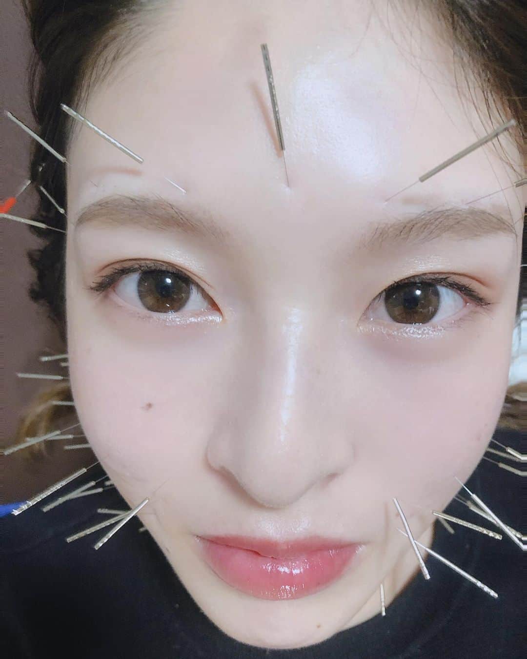 成田健人のインスタグラム：「嫁の顔にハリセンボン。  #美容鍼」