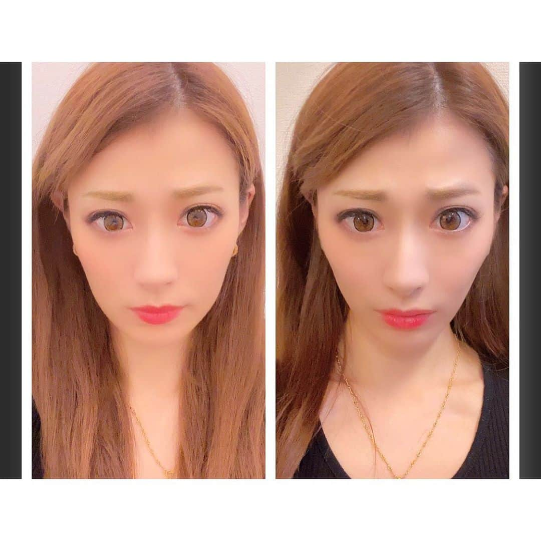 華沢友里奈さんのインスタグラム写真 - (華沢友里奈Instagram)「銀座にある @a_clinic_ginza  にリフトアップの糸 Aスレッドと  年齢的に気になる法令線を なくすための グロースファクター  そして昔から気になってる目のクマのところには サーモン注射を打ちに行ってきました❤️ 二枚目の写真は Aスレッド 左ビフォー右アフター 全く痛くなかったし すごい効果すぎてびっくりしてます…  注射の効果はもうしばらくしてから 出てくるみたいだから早く効果出ないかなあ❤️❤️ 店内とても綺麗だし対応もめっちゃいいし先生もとても親切な先生でした❤️❤️❤️ @dr.taniguchi  ありがとうございます❤️ #銀座aclinic  #aクリニック  #エークリニック  #aスレッド #小顔aスレッド　#美容外科　 #美容皮膚科　#美容クリニック #谷口弘樹　#グロースファスター #サーモン注射　#目の下のくま #pdrn  #ほうれいせん  #リフトアップ」10月24日 20時53分 - hanazawayurina