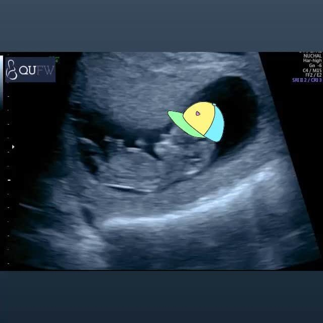 ブロンテ・バラットのインスタグラム：「@pattmurphy22 and I are having a baby!! Mini Murphy due May 2020 🤰🥰💃🏻👶🏻🇮🇹」