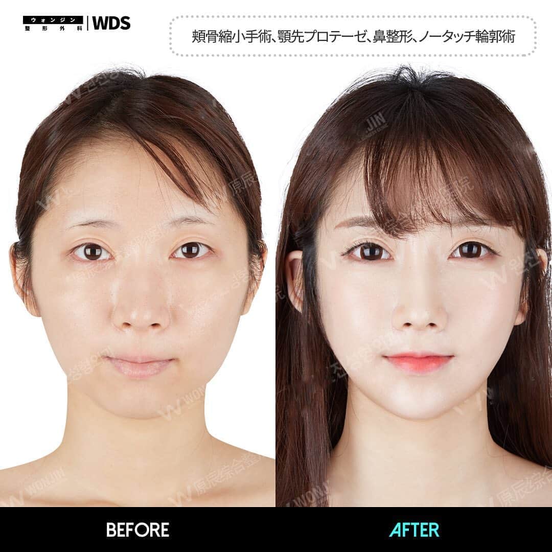 ウォンジン美容整形外科 皮膚科さんのインスタグラム写真 ウォンジン美容整形外科 皮膚科instagram Wdsウォンジン整形外科 日本人モデルユイさん マルチ整形ビフォーアフター 手術内容 鼻整形 頬骨縮小 前顎プロテーゼ ノータッチ輪郭術 今年最後の