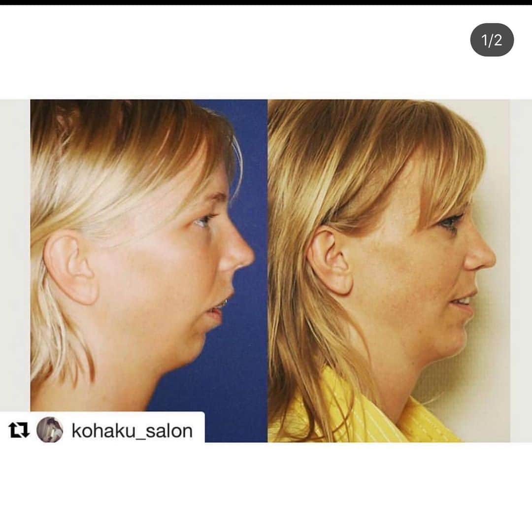 Kogao2さんのインスタグラム写真 Kogao2instagram 下記の項目のうち いくつか当てはまるものがある場合アデノイド顔貌の可能性があります １ あごがほとんどない ２ 面長 ３ 歯並びが悪い ４ 気づいたら口呼吸をしている ５ 口を閉じにくい 口を閉じると