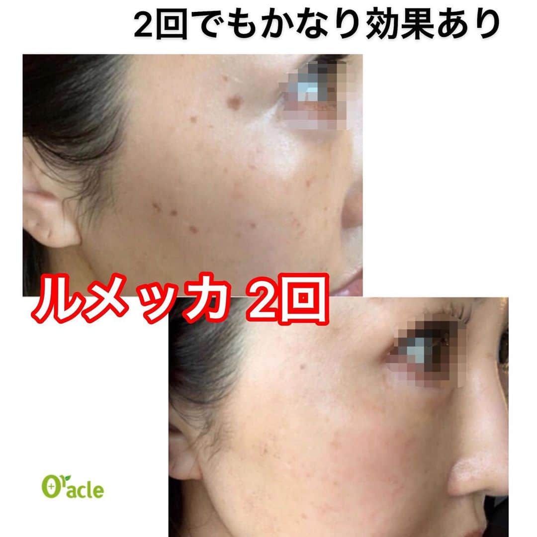 オラクル美容皮膚科東京新宿院さんのインスタグラム写真 - (オラクル美容皮膚科東京新宿院Instagram)「レーザーでシミは1回で取れる⁈🤔﻿ ﻿ よくこの質問をいただきます➡︎﻿ ﻿ ▪️▫️▪️▫️▪️▫️▪️▫️▪️▫️﻿ ﻿ スポットと言われるシミ取りレーザーで1回でシミを取る治療もありますが、施術中の痛みやダウンタイムも長く、しばらく絆創膏で過ごすというデメリットがあります。﻿ またスポットはシミの患部のみ治療になります。﻿ ﻿ ▪️▫️▪️▫️▪️▫️▪️▫️▪️▫️﻿ ﻿ オラクルがおすすめする﻿ 『ルメッカ』でのシミ治療では、1回でシミが取れる場合もありますが、ほとんど場合は回数が必要となります🧐﻿ ﻿ しかし、トーニングと比べると少ない回数で治療ができるのが特徴です👍﻿ ﻿ 痛みもほとんどなく﻿ その日からメイクもでき﻿ ダウンタイムはほとんどありません👌﻿ ﻿ ▪️▫️▪️▫️▪️▫️▪️▫️▪️▫️﻿ ﻿ そして…﻿ ただシミを取るだけではなく、﻿ 光と熱の作用により﻿ コラーゲン線維やエラスチンの再生が促されるため、﻿ ﻿ お肌にハリやツヤを出し、お肌全体を美しく整えます✨✨✨﻿ ﻿ それによりシミやくすみが改善され、ツヤのある若々しいお肌になります⤴️﻿ ﻿ ▪️▫️▪️▫️▪️▫️▪️▫️▪️▫️﻿ ﻿ シミの状態にもよりますが、﻿ 回数の目安は3回〜5回﻿ ﻿ 3回でもお肌がキレイに整う方が多いです✨﻿ 肌トーンは1-2回でも上がります✨﻿ ﻿ シミ治療だけではない、お肌全体を美しく整える【ルメッカ】﻿ ﻿ 秋から冬は紫外線が弱くなりますので、治療始めるベストシーズンです🍁﻿ ﻿ ▪️▫️▪️▫️▪️▫️▪️▫️▪️▫️﻿ ﻿ ⚠️ルメッカリスクなど⚠️﻿ 一時的にシミが濃くなる、数日瘡蓋、赤みやほてり感、乾燥など﻿ ﻿ ▪️▫️▪️▫️▪️▫️▪️▫️▪️▫️﻿ ﻿ シミ、赤ら顔、そばかすなどのご相談はお気軽にお問い合わせください。﻿ まずはカウンセリングだけでも🆗👌﻿ ﻿ ▪️▫️▪️▫️▪️▫️▪️▫️▪️▫️﻿ ﻿ 🇯🇵オラクル美容皮膚科🇰🇷﻿ 📍新宿3丁目19-4 MLJ新宿8階﻿ ﻿ 【専門】﻿ ニキビ（跡）／毛穴／シミ／しわ／たるみ／痩身／アンチエイジング／美白美肌全般／ブライダル相談﻿ ﻿ 🗝完全予約制﻿ 👠土日祝日も診療﻿ ﻿ 【予約方法】﻿ ☎0120-905-696﻿ ⏰9:00～21:00［年中無休］﻿ ﻿ LINE、メール24時間📧﻿ LINE🆔 @oracle.jp ﻿ 📩HPメールフォームよりお願いいたします﻿ ﻿ ▪️▫️▪️▫️▪️▫️▪️▫️▪️▫️﻿ #オラクル美容皮膚科 #オラクル #美容皮膚科 #ルメッカ #IPL #シミ #そばかす#シミ取りレーザー #美肌 #フォトフェイシャル #シミ治療 #シミレーザー #ピコシュア #ピコトーニング #赤ら顔 #しみ #鎮静管理 #再生管理﻿ #韓国美容  #美容女子 #美容オタクさんと繋がりたい #シミケア #しみそばかす #シミ取り #シミ消し #シミ取りレーザ」10月25日 9時03分 - oraclejp