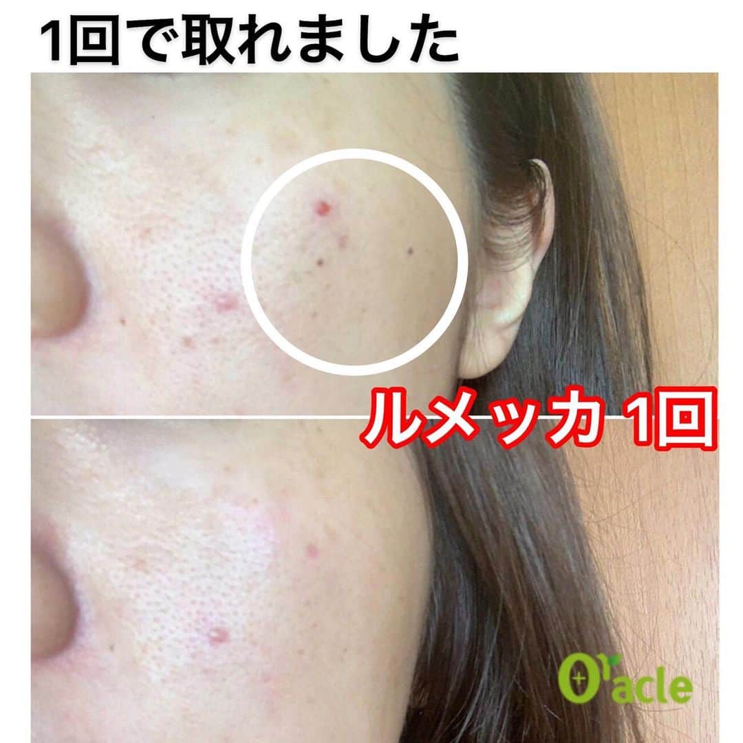 オラクル美容皮膚科東京新宿院さんのインスタグラム写真 - (オラクル美容皮膚科東京新宿院Instagram)「レーザーでシミは1回で取れる⁈🤔﻿ ﻿ よくこの質問をいただきます➡︎﻿ ﻿ ▪️▫️▪️▫️▪️▫️▪️▫️▪️▫️﻿ ﻿ スポットと言われるシミ取りレーザーで1回でシミを取る治療もありますが、施術中の痛みやダウンタイムも長く、しばらく絆創膏で過ごすというデメリットがあります。﻿ またスポットはシミの患部のみ治療になります。﻿ ﻿ ▪️▫️▪️▫️▪️▫️▪️▫️▪️▫️﻿ ﻿ オラクルがおすすめする﻿ 『ルメッカ』でのシミ治療では、1回でシミが取れる場合もありますが、ほとんど場合は回数が必要となります🧐﻿ ﻿ しかし、トーニングと比べると少ない回数で治療ができるのが特徴です👍﻿ ﻿ 痛みもほとんどなく﻿ その日からメイクもでき﻿ ダウンタイムはほとんどありません👌﻿ ﻿ ▪️▫️▪️▫️▪️▫️▪️▫️▪️▫️﻿ ﻿ そして…﻿ ただシミを取るだけではなく、﻿ 光と熱の作用により﻿ コラーゲン線維やエラスチンの再生が促されるため、﻿ ﻿ お肌にハリやツヤを出し、お肌全体を美しく整えます✨✨✨﻿ ﻿ それによりシミやくすみが改善され、ツヤのある若々しいお肌になります⤴️﻿ ﻿ ▪️▫️▪️▫️▪️▫️▪️▫️▪️▫️﻿ ﻿ シミの状態にもよりますが、﻿ 回数の目安は3回〜5回﻿ ﻿ 3回でもお肌がキレイに整う方が多いです✨﻿ 肌トーンは1-2回でも上がります✨﻿ ﻿ シミ治療だけではない、お肌全体を美しく整える【ルメッカ】﻿ ﻿ 秋から冬は紫外線が弱くなりますので、治療始めるベストシーズンです🍁﻿ ﻿ ▪️▫️▪️▫️▪️▫️▪️▫️▪️▫️﻿ ﻿ ⚠️ルメッカリスクなど⚠️﻿ 一時的にシミが濃くなる、数日瘡蓋、赤みやほてり感、乾燥など﻿ ﻿ ▪️▫️▪️▫️▪️▫️▪️▫️▪️▫️﻿ ﻿ シミ、赤ら顔、そばかすなどのご相談はお気軽にお問い合わせください。﻿ まずはカウンセリングだけでも🆗👌﻿ ﻿ ▪️▫️▪️▫️▪️▫️▪️▫️▪️▫️﻿ ﻿ 🇯🇵オラクル美容皮膚科🇰🇷﻿ 📍新宿3丁目19-4 MLJ新宿8階﻿ ﻿ 【専門】﻿ ニキビ（跡）／毛穴／シミ／しわ／たるみ／痩身／アンチエイジング／美白美肌全般／ブライダル相談﻿ ﻿ 🗝完全予約制﻿ 👠土日祝日も診療﻿ ﻿ 【予約方法】﻿ ☎0120-905-696﻿ ⏰9:00～21:00［年中無休］﻿ ﻿ LINE、メール24時間📧﻿ LINE🆔 @oracle.jp ﻿ 📩HPメールフォームよりお願いいたします﻿ ﻿ ▪️▫️▪️▫️▪️▫️▪️▫️▪️▫️﻿ #オラクル美容皮膚科 #オラクル #美容皮膚科 #ルメッカ #IPL #シミ #そばかす#シミ取りレーザー #美肌 #フォトフェイシャル #シミ治療 #シミレーザー #ピコシュア #ピコトーニング #赤ら顔 #しみ #鎮静管理 #再生管理﻿ #韓国美容  #美容女子 #美容オタクさんと繋がりたい #シミケア #しみそばかす #シミ取り #シミ消し #シミ取りレーザ」10月25日 9時03分 - oraclejp