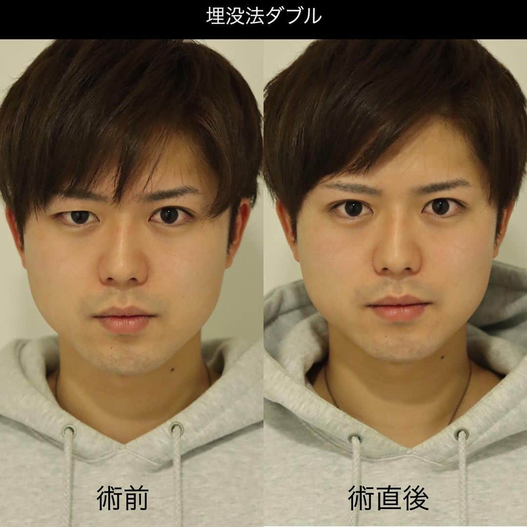東京イセアクリニックさんのインスタグラム写真 東京イセアクリニックinstagram 埋没法ダブルでより取れにくい二重に 二重になりたい と言ったご希望の患者様 施術担当医 スズキ Chika Isea 埋没法ダブルとは 強固な留め方