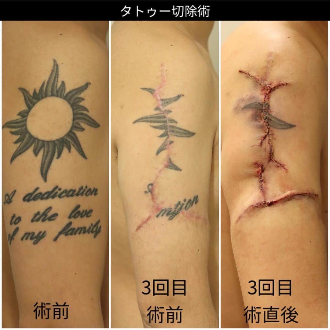 東京イセアクリニックさんのインスタグラム写真 - (東京イセアクリニックInstagram)「タトゥーの切除術 🙅🏻🙅🏻‍♂️ . 肩から二の腕に大きく入ったタトゥーの除去を 希望された患者様🗣🗣 ↓↓↓↓↓ 担当医師:ヨシタネ . タトゥーがあることで生き辛くなったので、消したい というご希望でしたので 回数を分けて【切除】している途中経過👨🏻‍⚕️💉 . 写真左:before 写真中央:2回目切除3ヶ月後(3回目手術前) 写真右:3回目切除直後 . 切除の回数が重なると一部分細くなりますが 時間の経過とともに馴染みます👼🏻✨ . あともう一回の切除で終了予定です👨‍⚕️ . . 🌻再診の目安🌻 ○2.3日後に圧迫固定解除 ○7-10日程度で抜糸 ○1ヶ月後に診察 となります🏥  タトゥーサイズ13×13cm+12×6cm¥1100000〜 (サイズによって料金は変わります) . 😖麻酔の痛み →痛みが心配な方は笑気麻酔が使用出来ます🌟 ⚠️創部に鈍い痛み:1-2週間程度 ⚠️傷の赤み・引きつれ:3-6ヶ月 🌻テープ保護:3-6ヶ月 →綺麗な傷跡にする為にテープ保護が必要になります🌟 . . タトゥーを消すには理由が各々😖💦 患者さまのニーズに合わせた治療法を 提案いたします💁🏼‍♀️💁🏼‍♂️ . *他院で断られたけど消したい *傷跡を残さずにタトゥーを消したい *就職までにタトゥーを消したい *ダウンタイムなく安く消したい . LINEでもカウンセリングを承っております💌 お気軽にお問い合わせ下さい👩🏻‍⚕️✨ . #銀座#ginza  #iseaclinic#イセアクリニック #美容整形#美容外科#美容皮膚科  #吉種克之 #タトゥー#刺青#刺青除去#タトゥー除去#tattoo #タトゥー女子#切除 #切除術 #植皮 #ピコ#ピコレーザー#picoway#モニター募集 #LINEカウンセリング#カウンセリング無料 #綺麗になりたい#可愛くなりたい」11月2日 19時41分 - iseaclinic