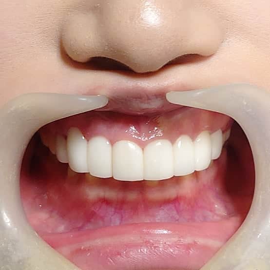 五十嵐一誠さんのインスタグラム写真 - (五十嵐一誠Instagram)「僕が造るセラミックアート作品  スーパーベニア８本です  歯茎の位置、歯のセンターの位置、 歯の方向、大きさ、形、etc 全てのデザインは 最も顔が美しく美人になるように 製作しています☺️ プロフェッショナル美容歯科医は 歯を変えることで美しく顔を変えます❗」11月18日 14時35分 - superdentist5