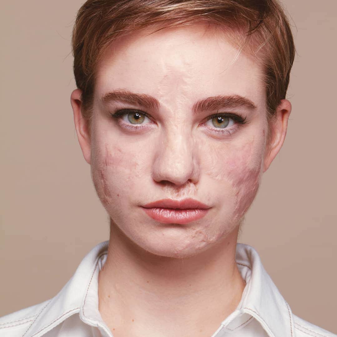 ベアトリーチェ・ヴィオのインスタグラム：「Queste cicatrici raccontano la mia storia. Sono parte di me e rappresentano la mia voglia di continuare a lottare. Per questo motivo ho scelto il fondotinta Accord Parfait di L'Oréal Paris, che rispecchia il colore della mia pelle, senza nasconderne le imperfezioni...perfette per me! . . @lorealmakeup #ad #AccordParfait #TutteNoiValiamo」