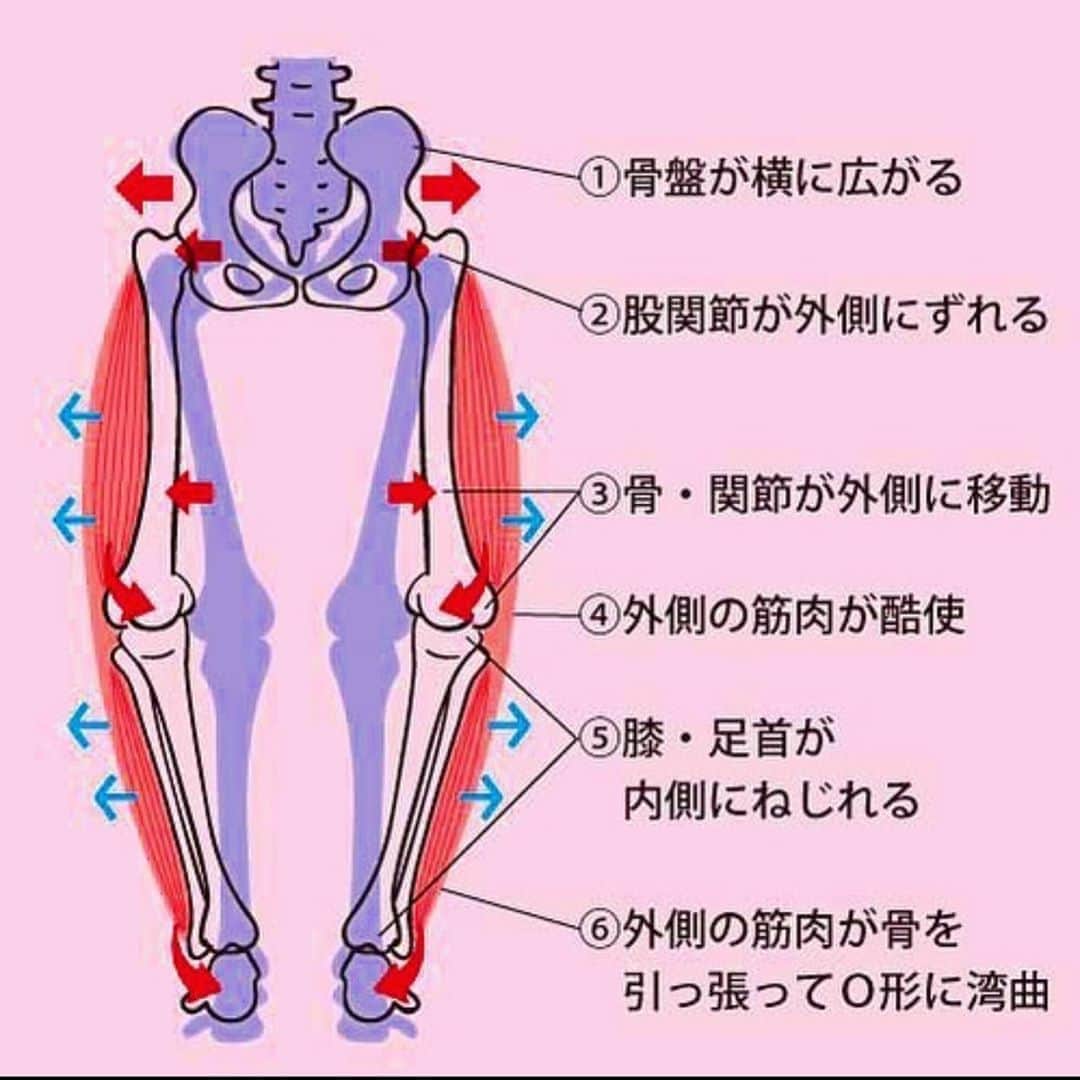 kogao283さんのインスタグラム写真 - (kogao283Instagram)「骨盤の歪みから、O脚へと変形するメカニズムは、 以下のとおりです。  骨盤が歪んで横に広がる 左右の股関節が外側にずれる 脚全体の骨・関節も外側に移動していく 筋肉の外側ばかりが酷使される 内側の筋肉は緩み、膝や足首も内側にねじれさせる 発達した外側の筋肉が、脚の骨を引っ張ってＯの形に湾曲させる  その原因は、 外傷や出産による影響 片側の筋肉ばかり使う生活習慣（同じ利き手で荷物をもつ、脚を組む等） 合わない靴・下着 運動不足による筋力低下 など様々なものが考えられます。」11月9日 5時34分 - kogao283